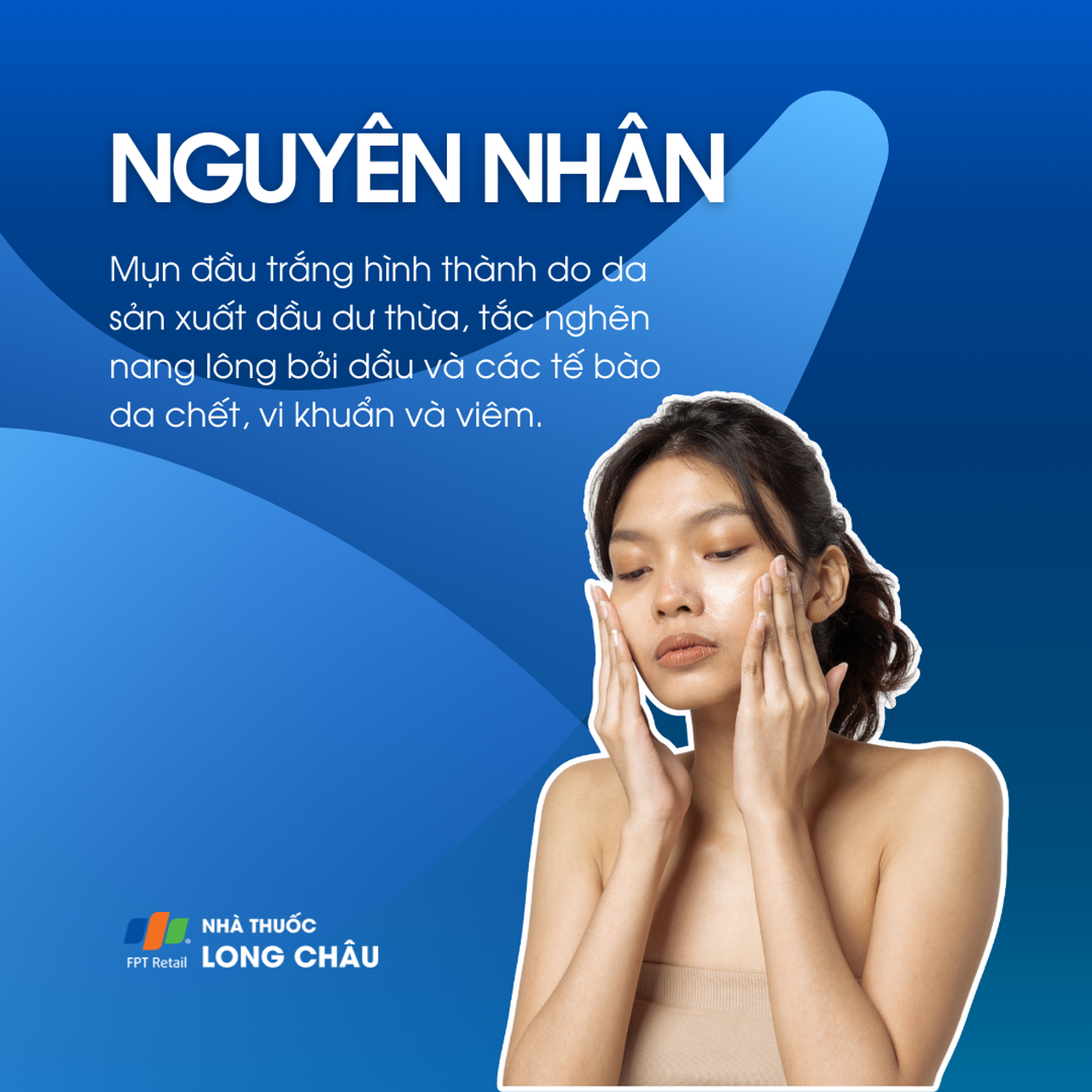 Mụn đầu trắng 3