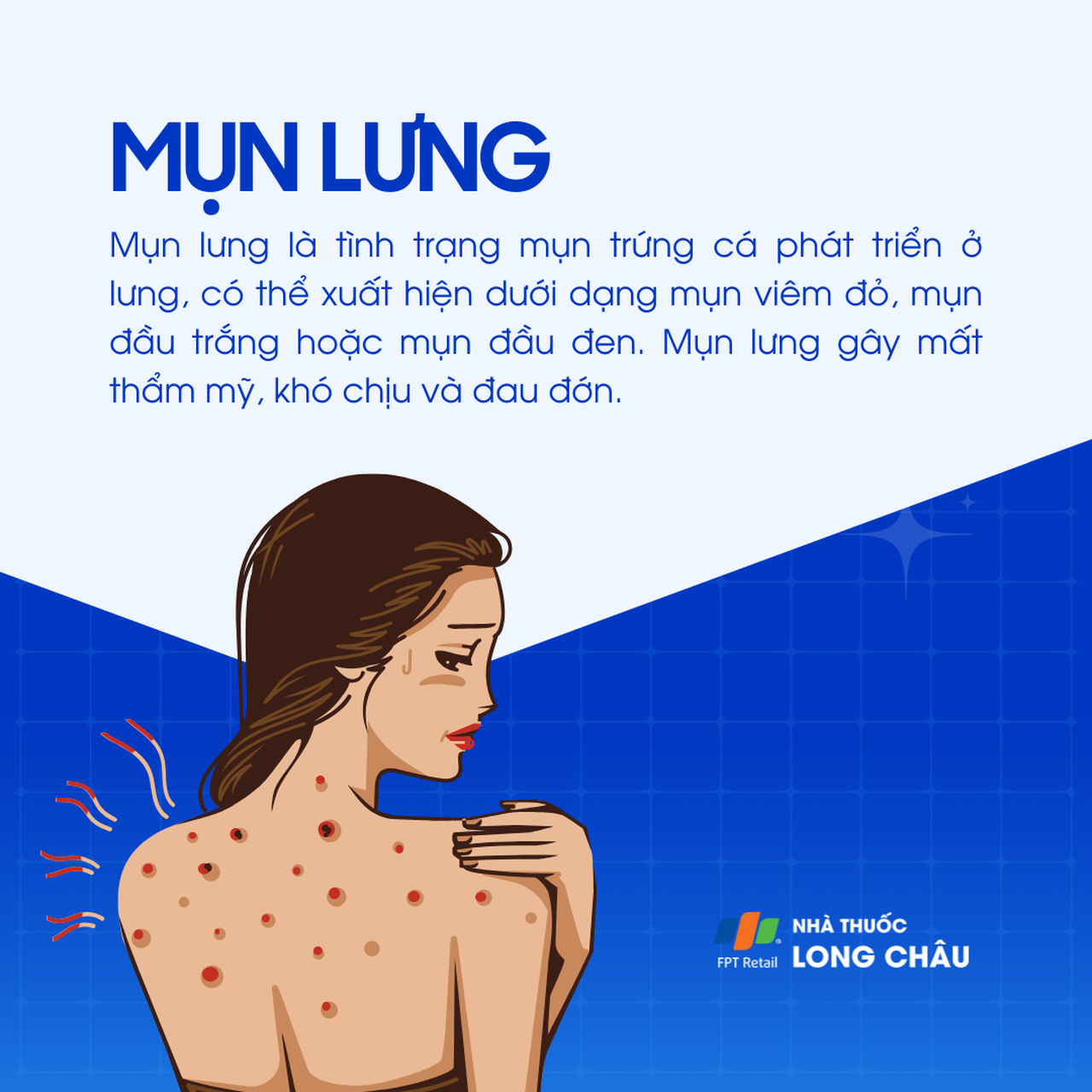 Mụn lưng 1