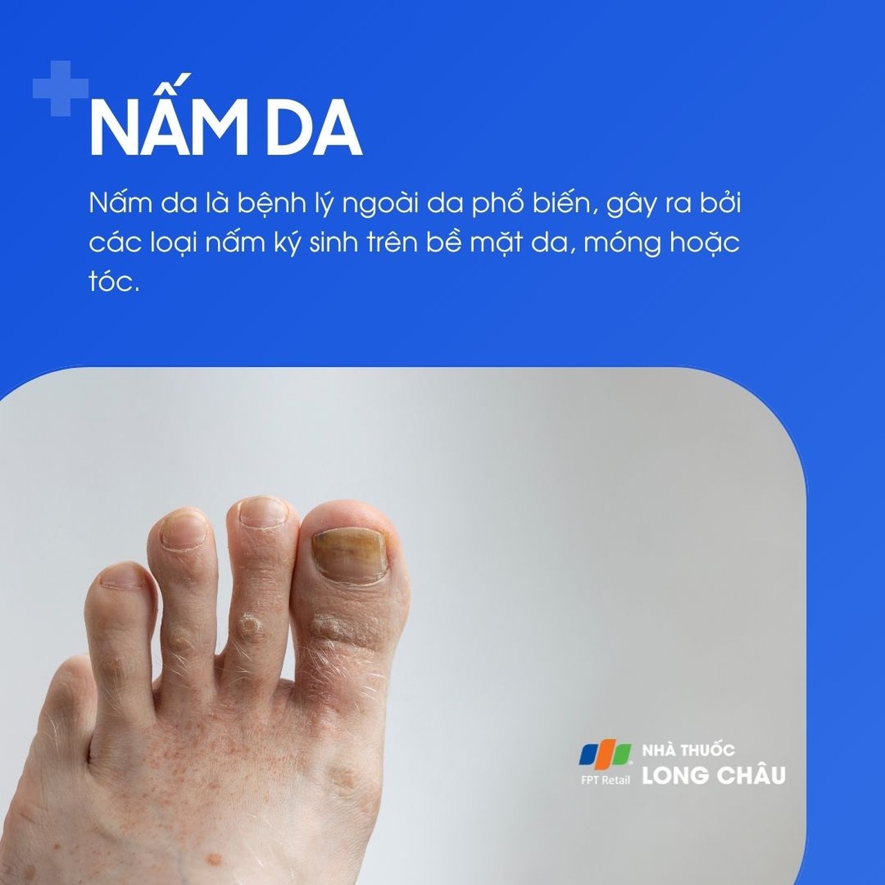 Nấm da là bệnh ngoài da phổ biến, do các loại nấm ký sinh gây ra trên bề mặt da, móng hoặc tóc