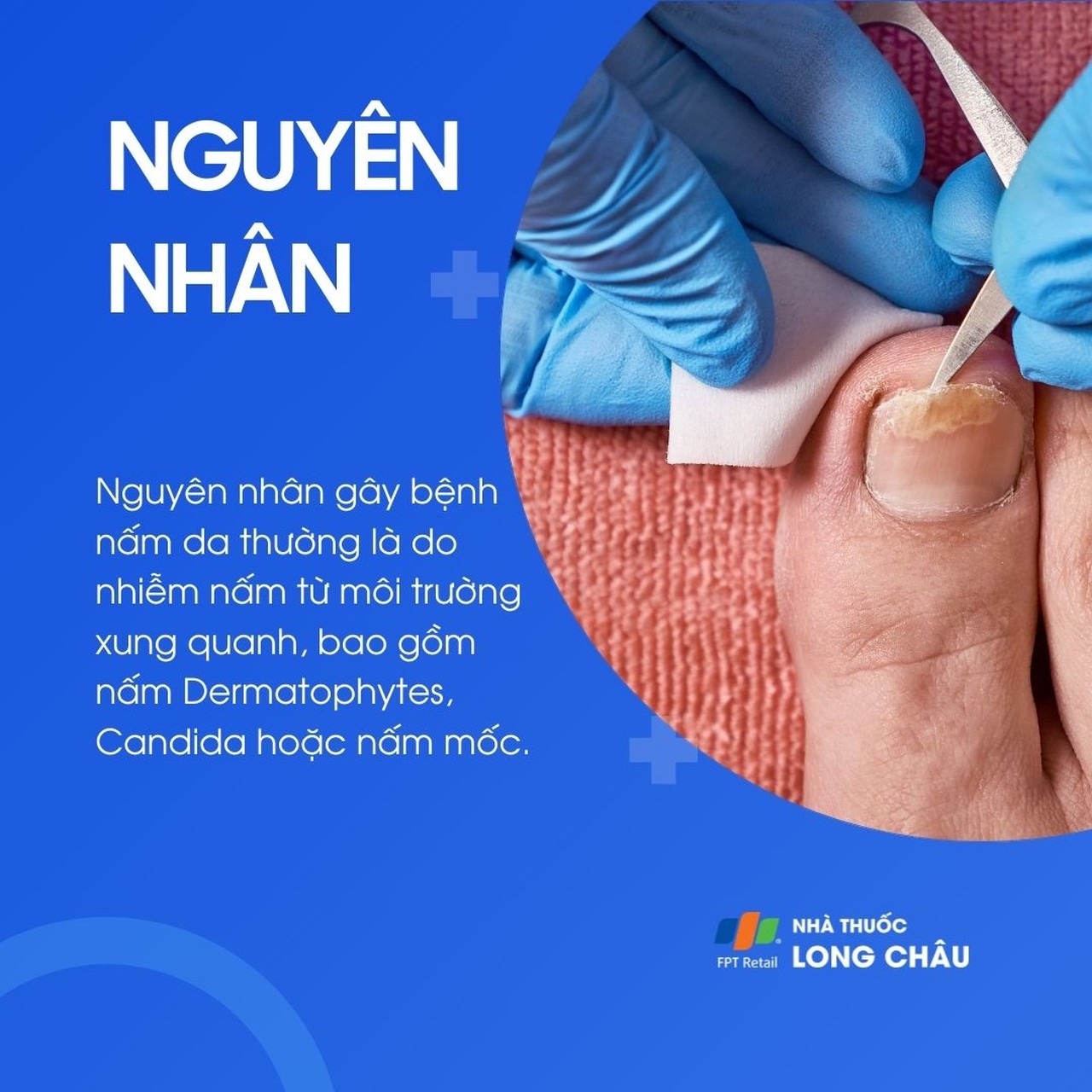 Do nhiễm nấm từ môi trường xung quanh như Dermatophytes, Candida, hoặc nấm mốc
