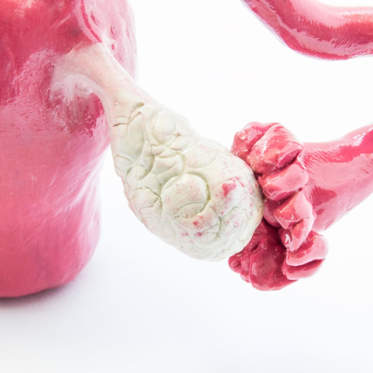 Nang naboth cổ tử cung 2