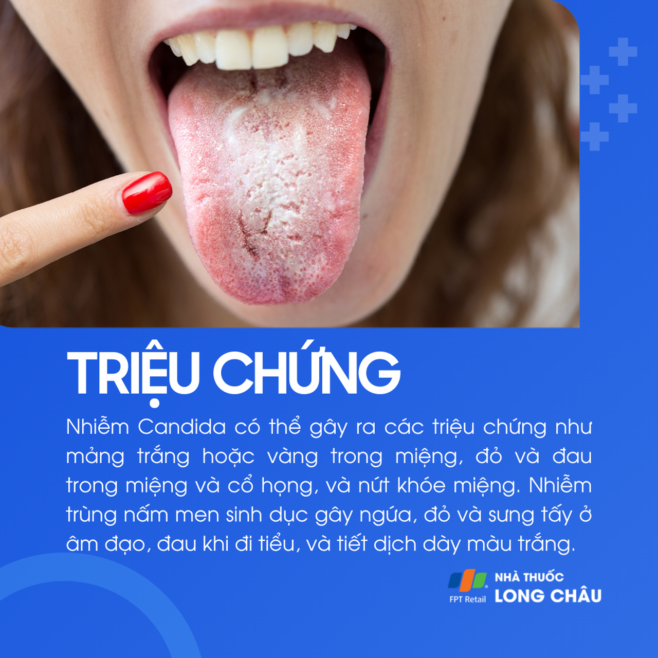 Triệu chứng nhiễm nấm Candida gồm: mảng trắng/vàng trong miệng, đau họng, nứt khóe miệng, ngứa và dịch âm đạo trắng đục