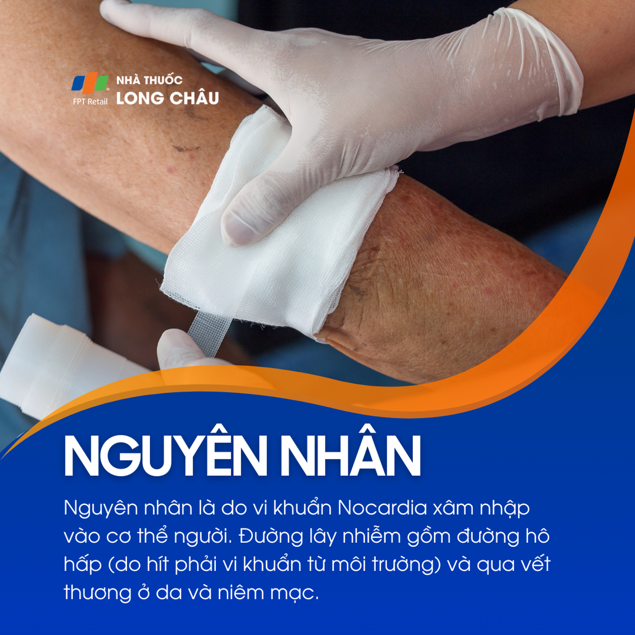 Nhiễm Nocardia 3