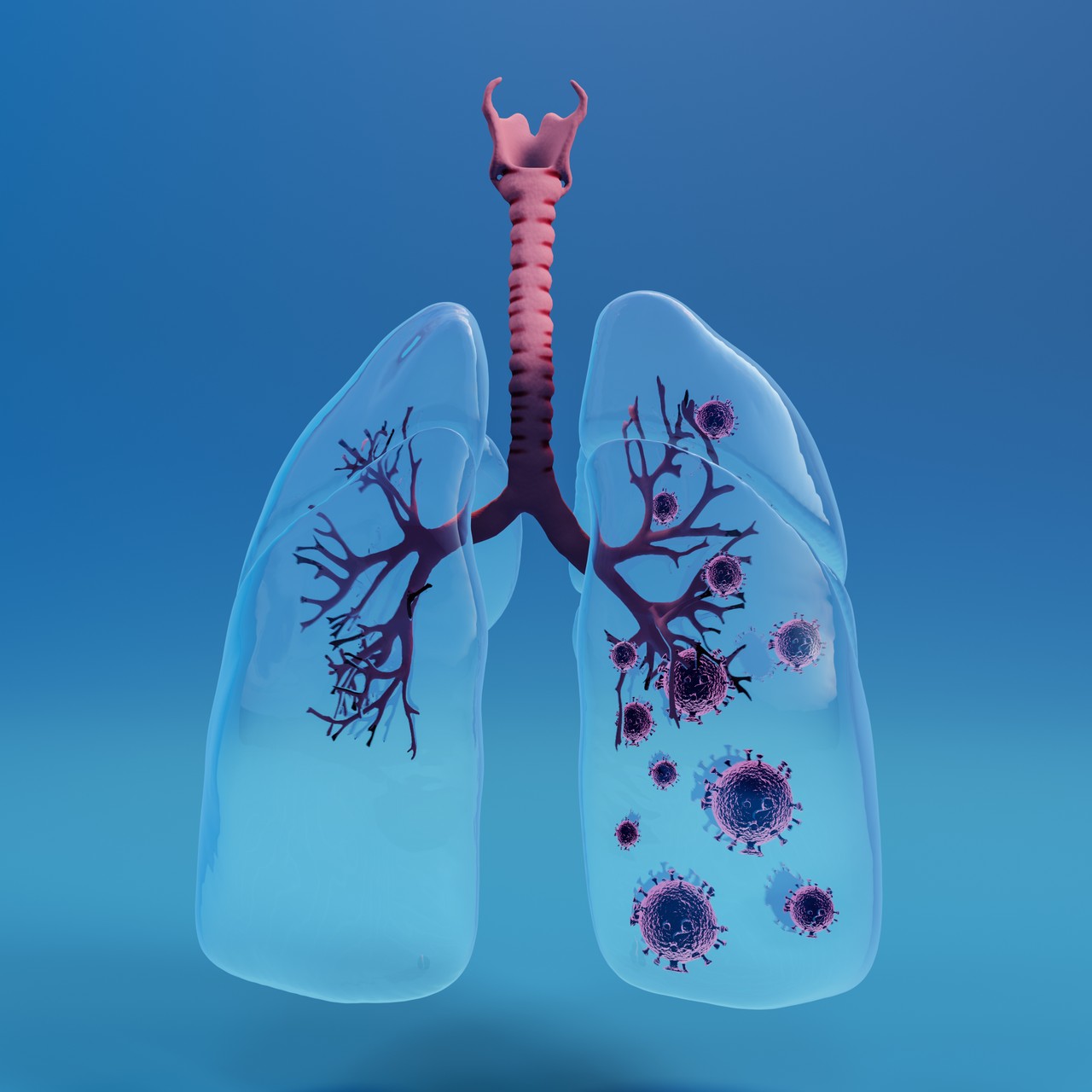 Nhiễm trùng đường hô hấp dưới là gì? Nguyên nhân, triệu chứng, điều trị và cách phòng ngừa 3