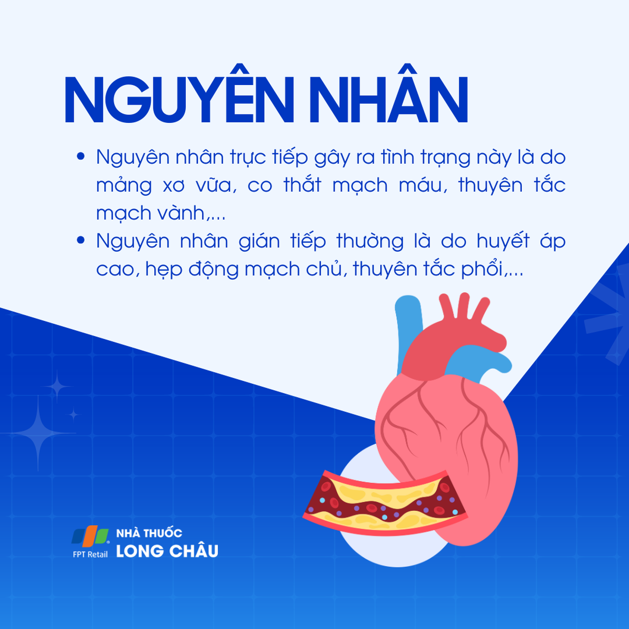 Nhồi máu cơ tim không ST chênh lên 3