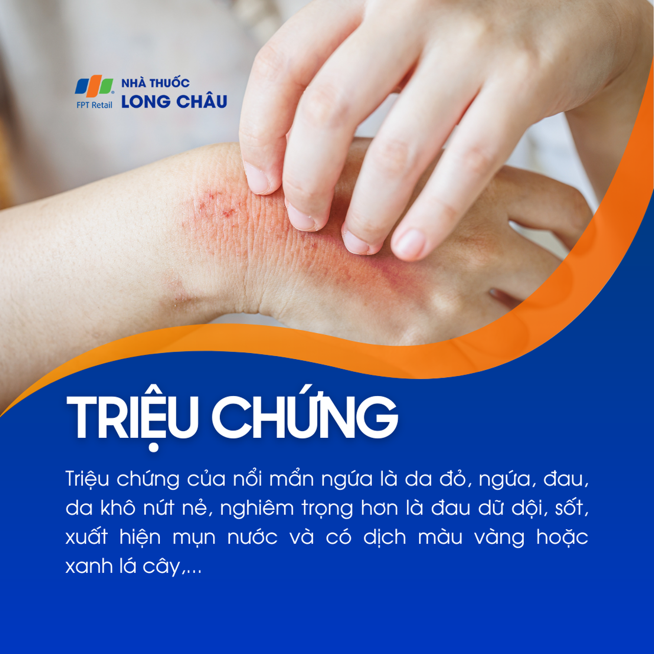 Nổi mẩn ngứa 2
