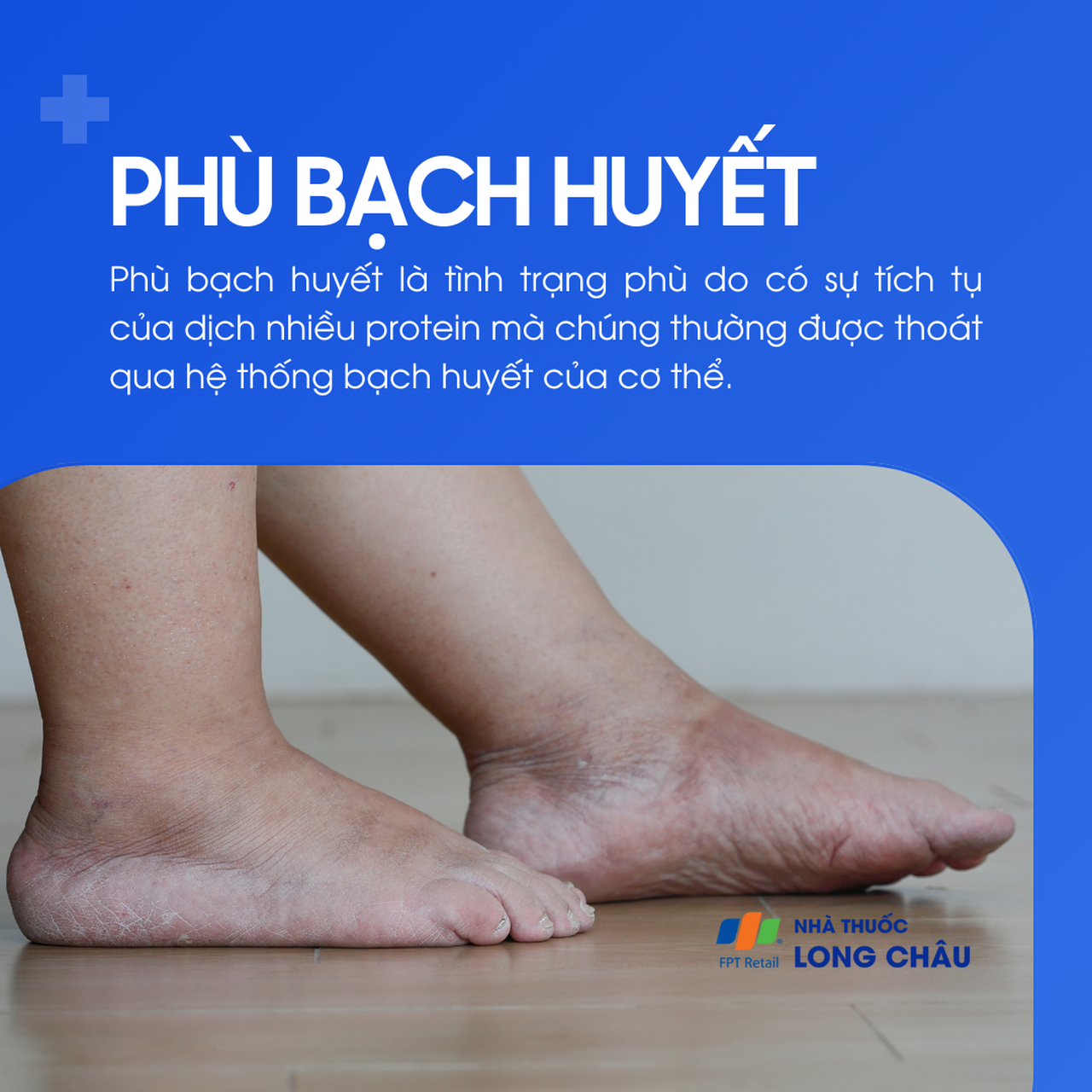 Phù bạch huyết 1