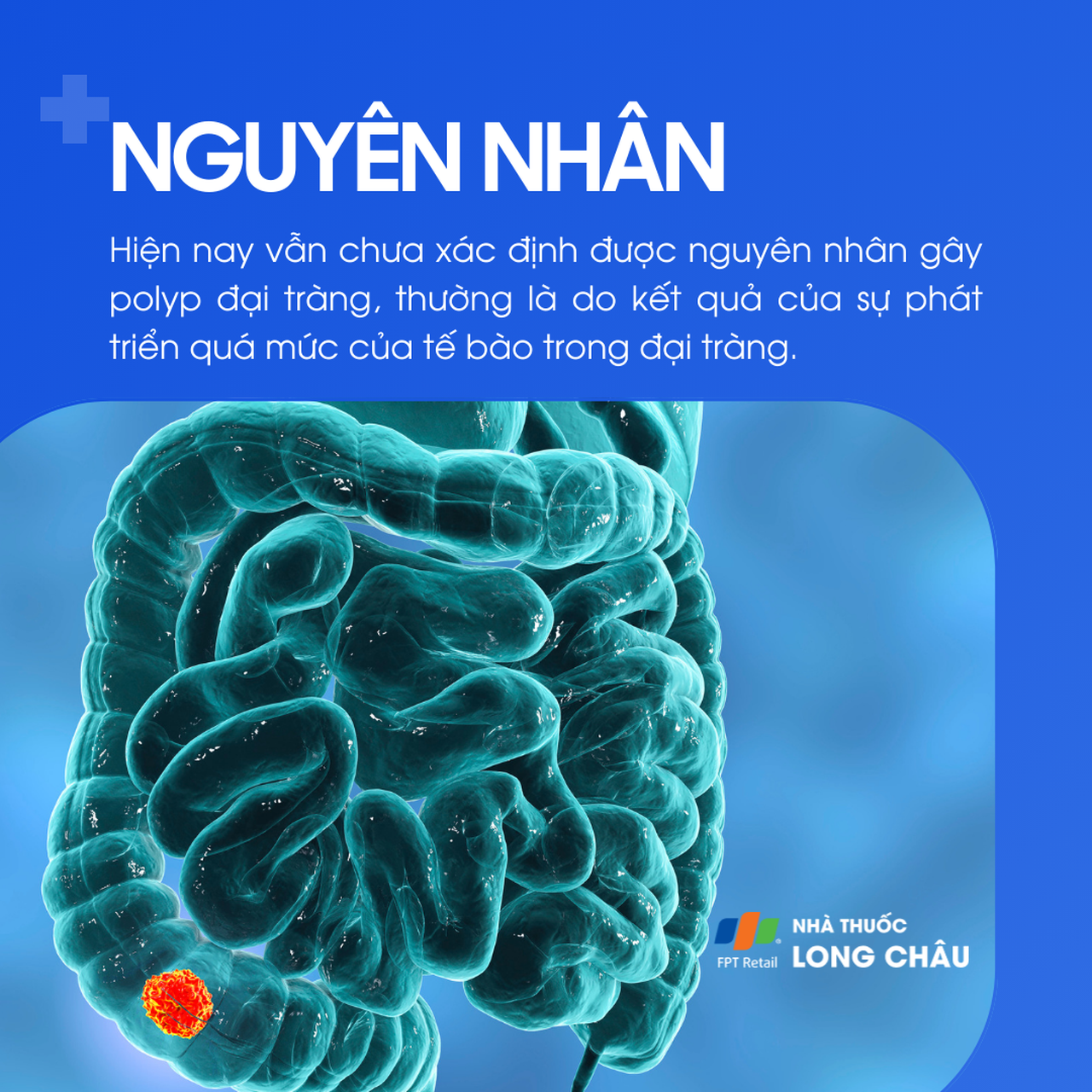 Polyp đại tràng 3
