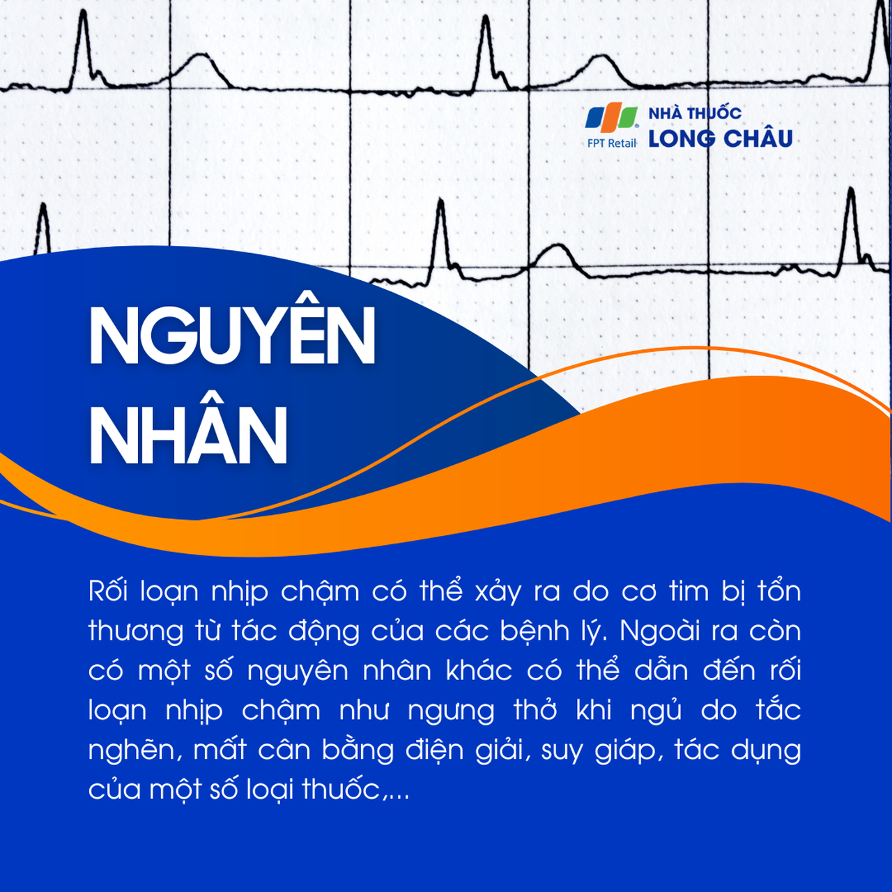 Rối loạn nhịp chậm 3