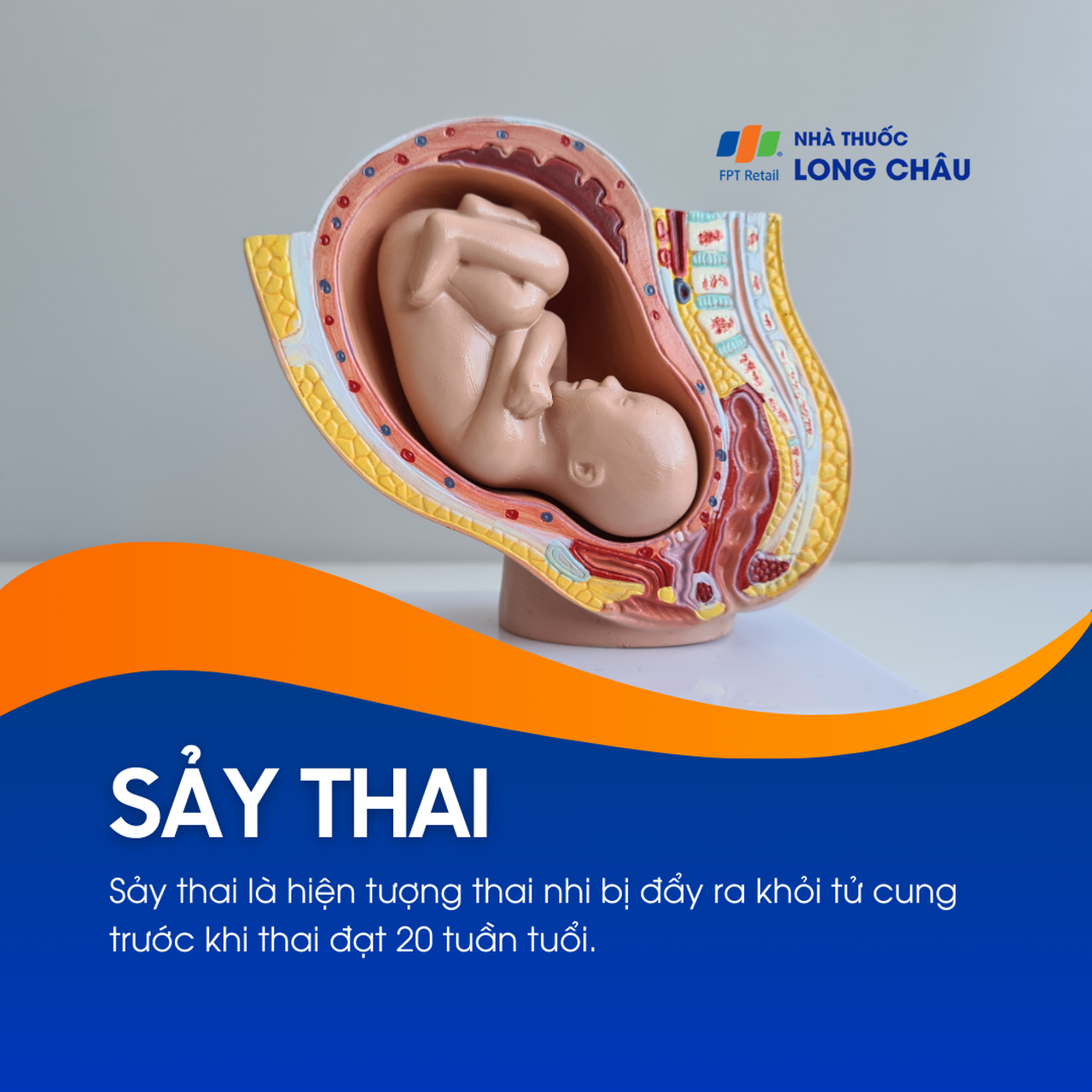 Sảy thai 1
