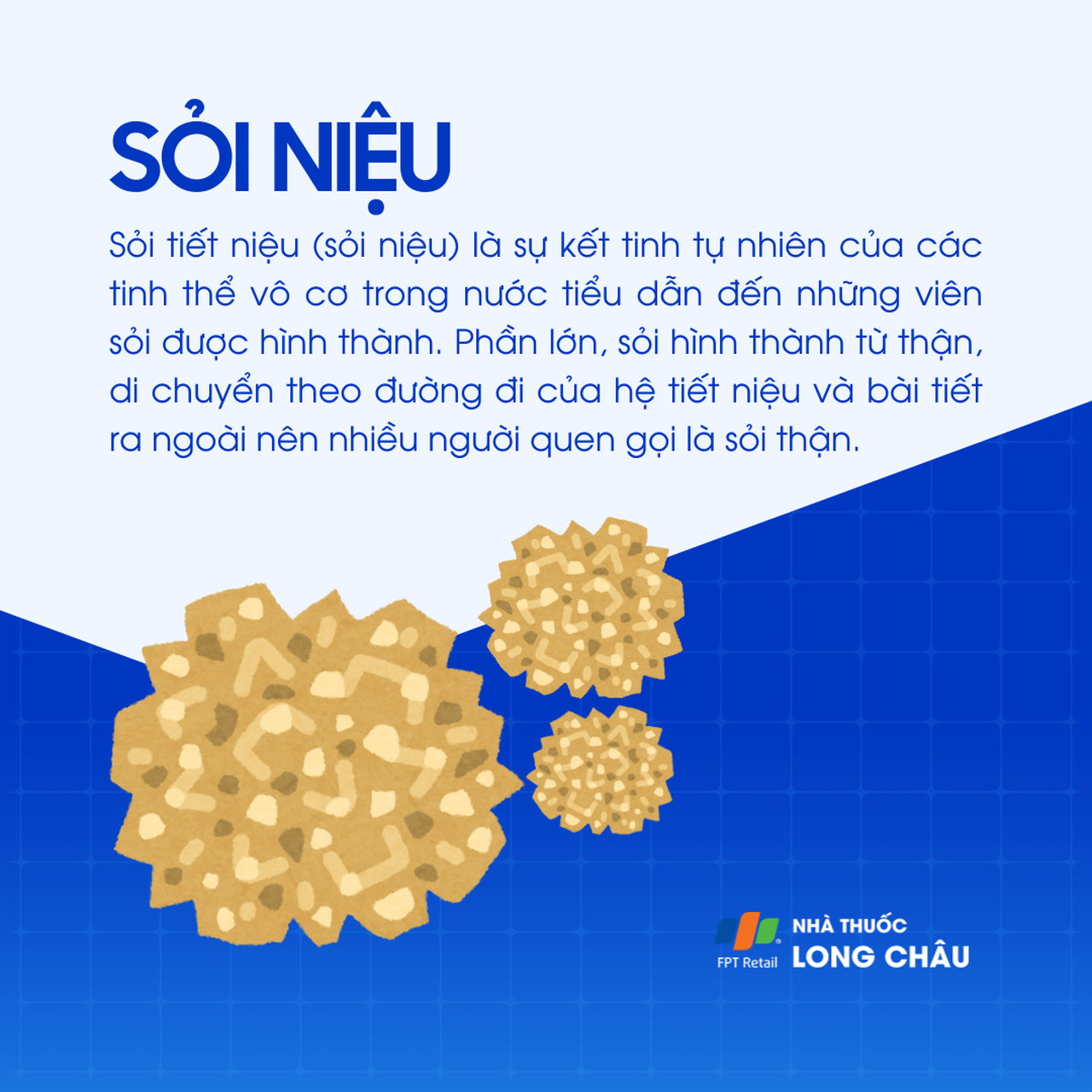 Sỏi niệu 1