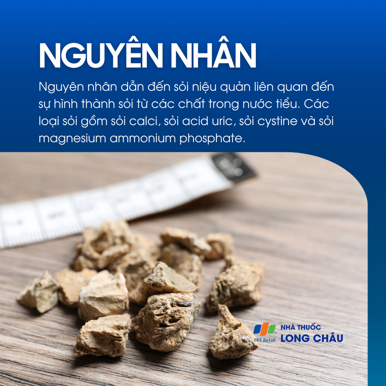 Sỏi niệu quản 3