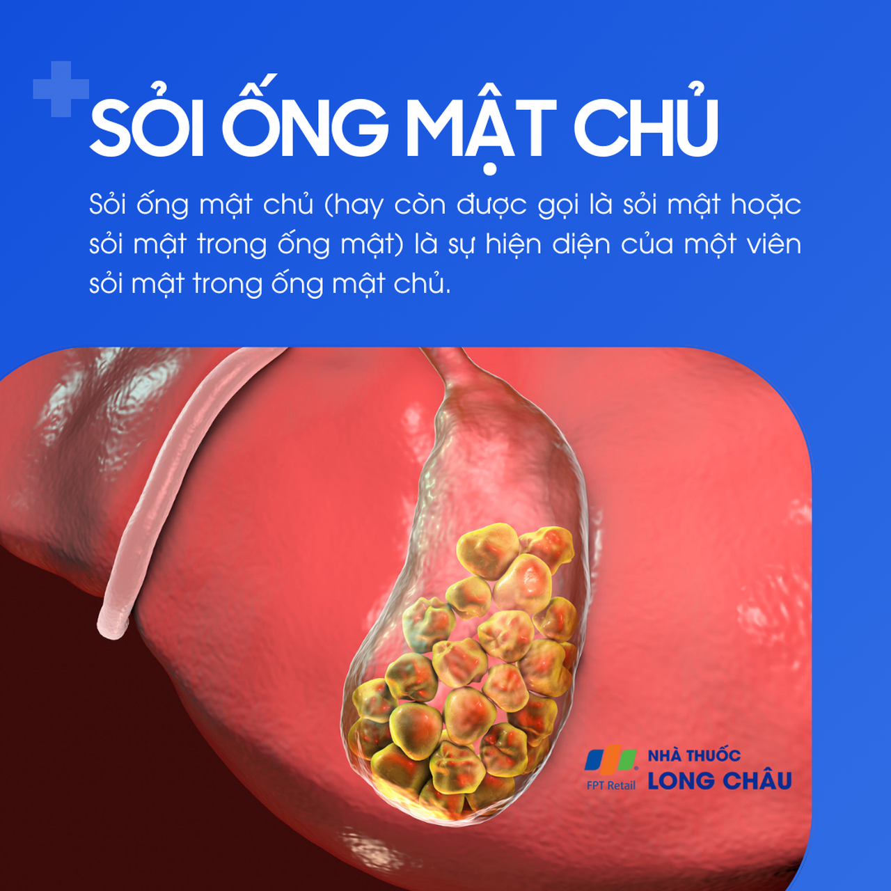 Sỏi ống mật chủ 1