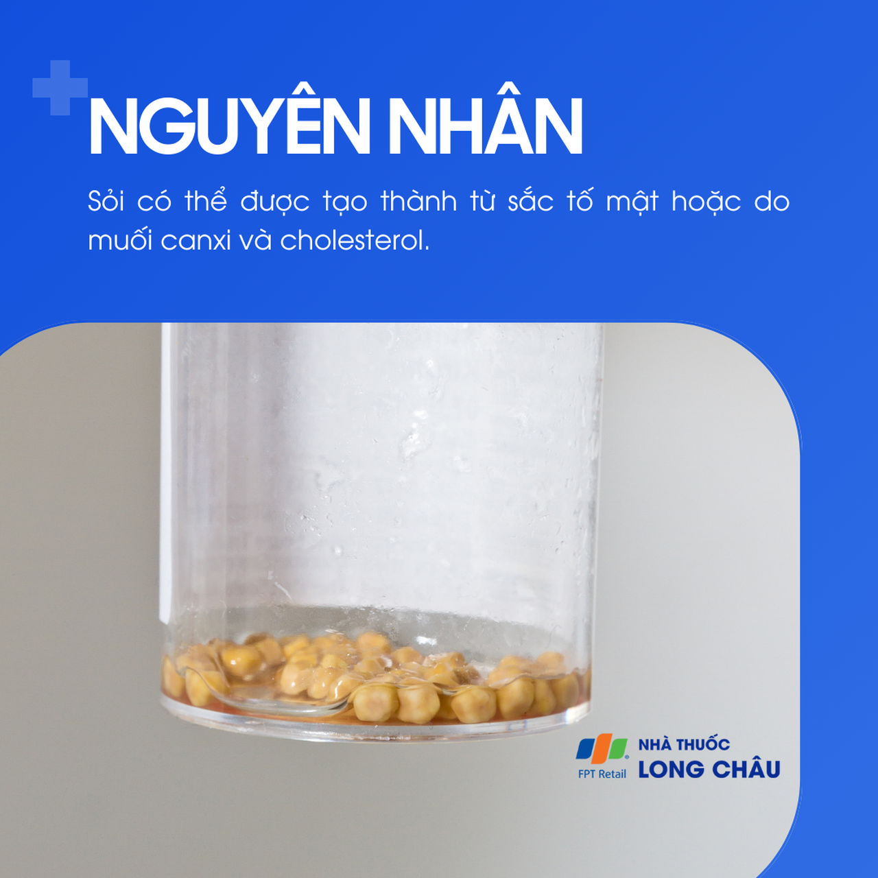 Sỏi ống mật chủ 3