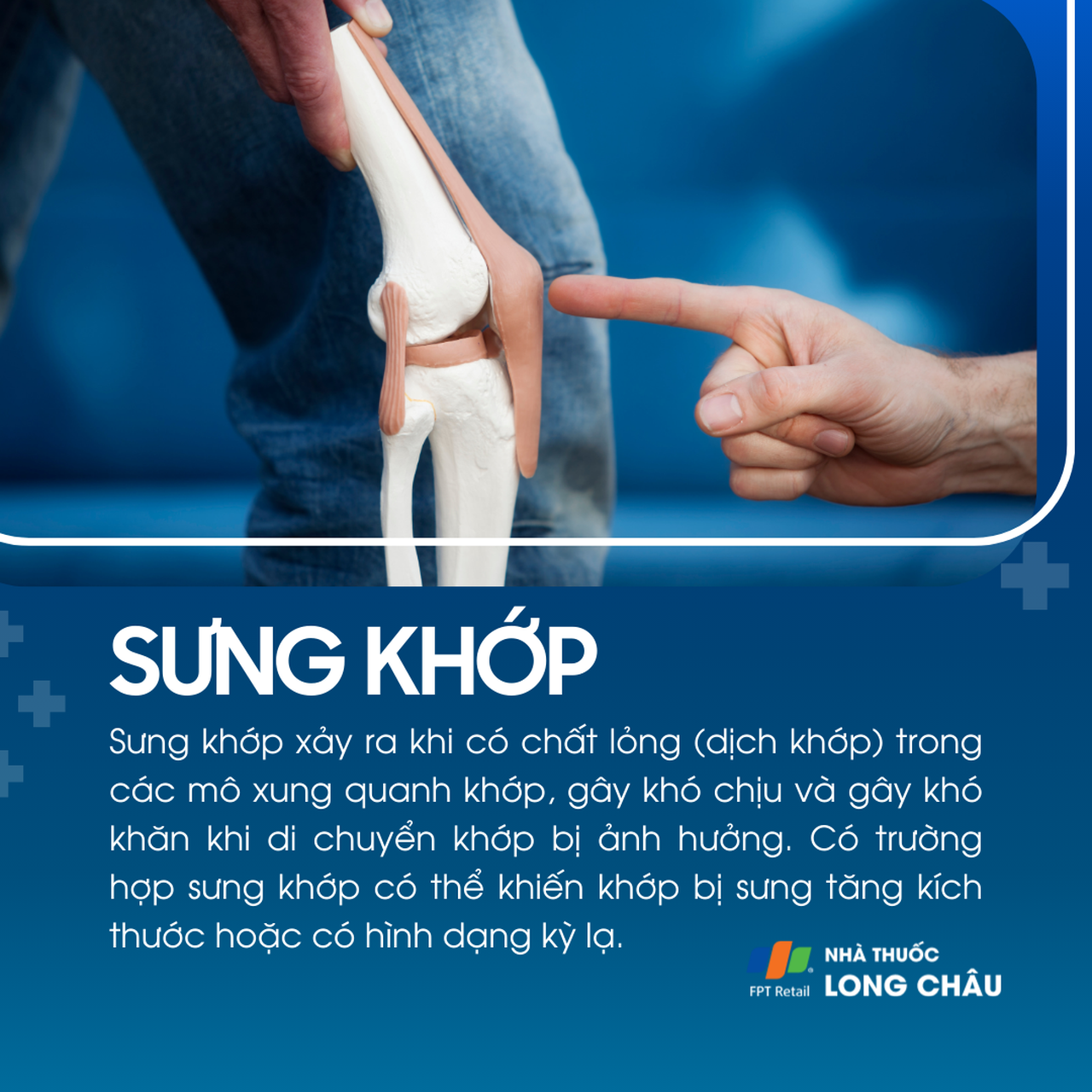Sưng khớp 1