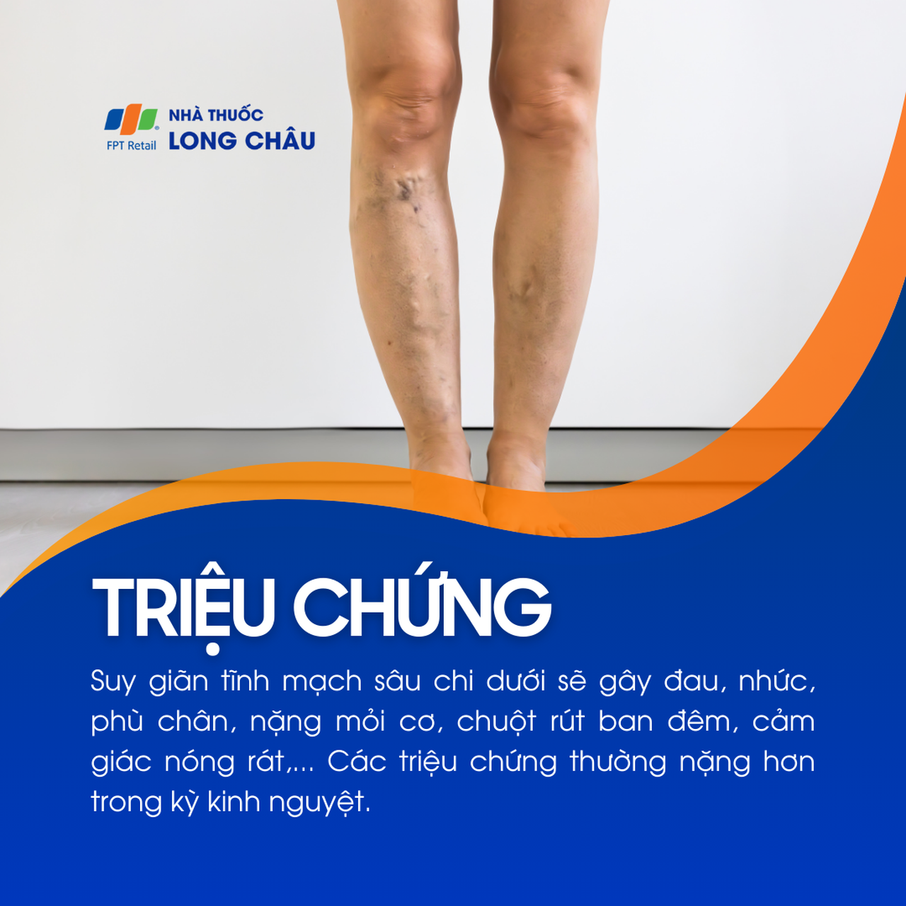 Suy giãn tĩnh mạch sâu chi dưới 2
