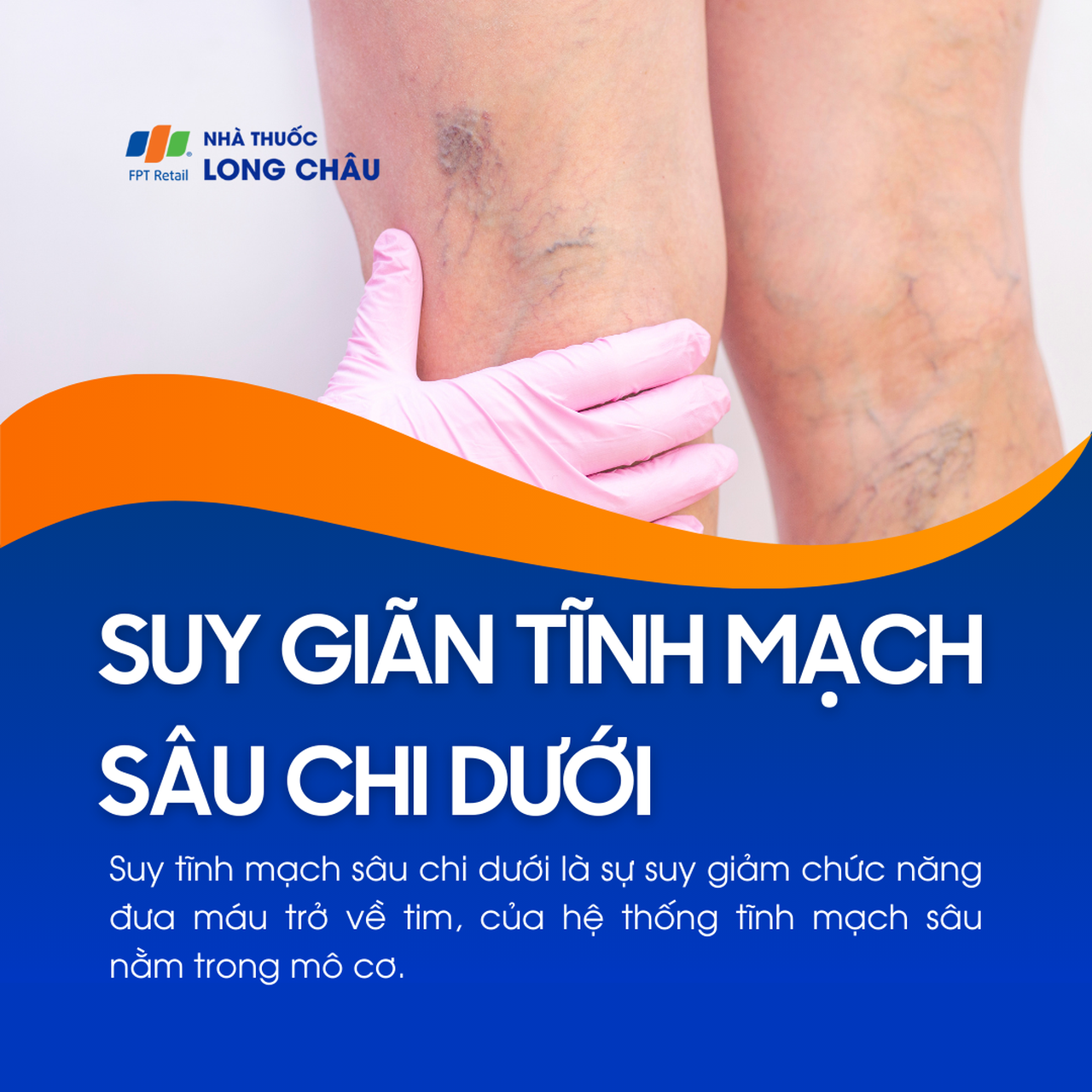 Suy giãn tĩnh mạch sâu chi dưới 1