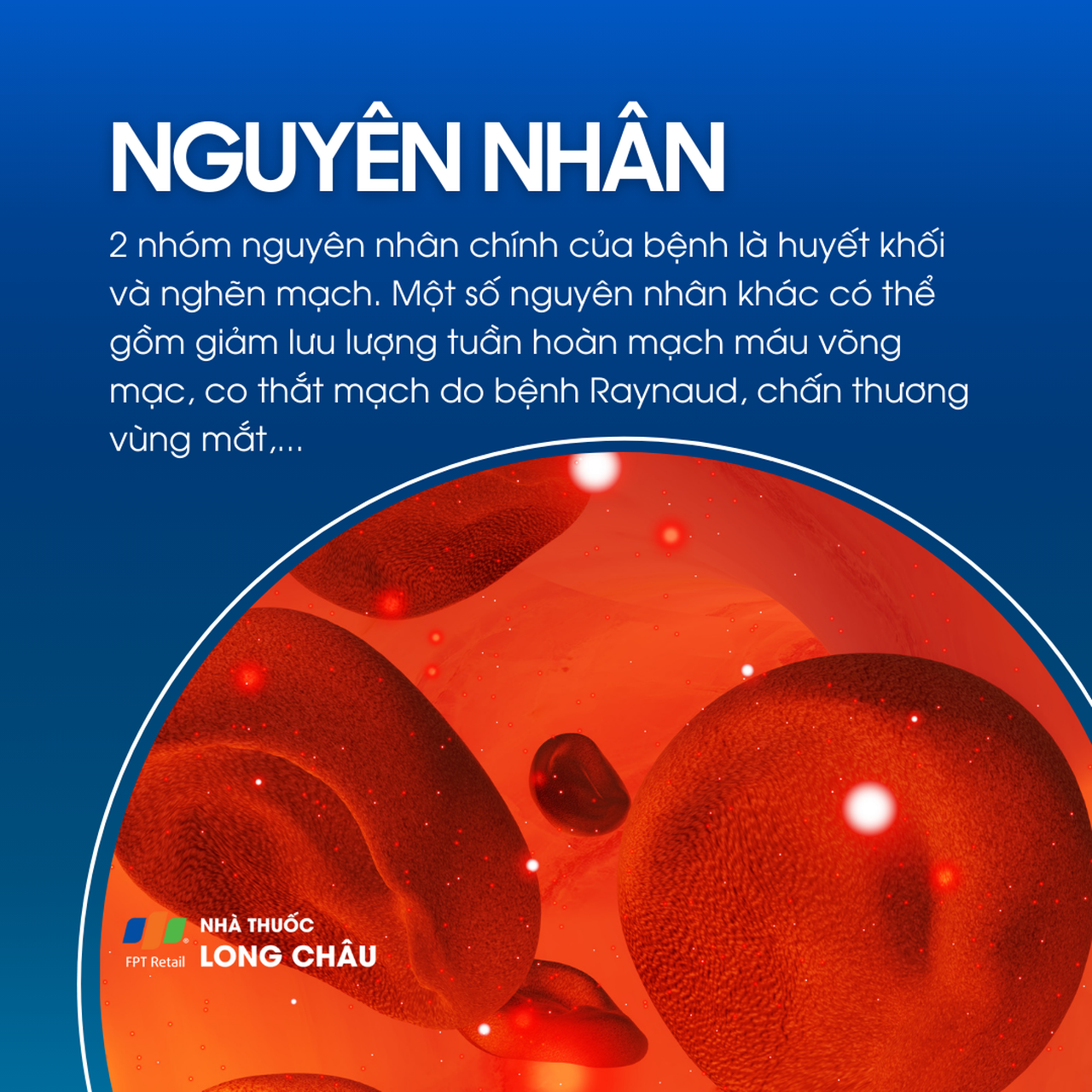 Tắc động mạch võng mạc trung tâm 3