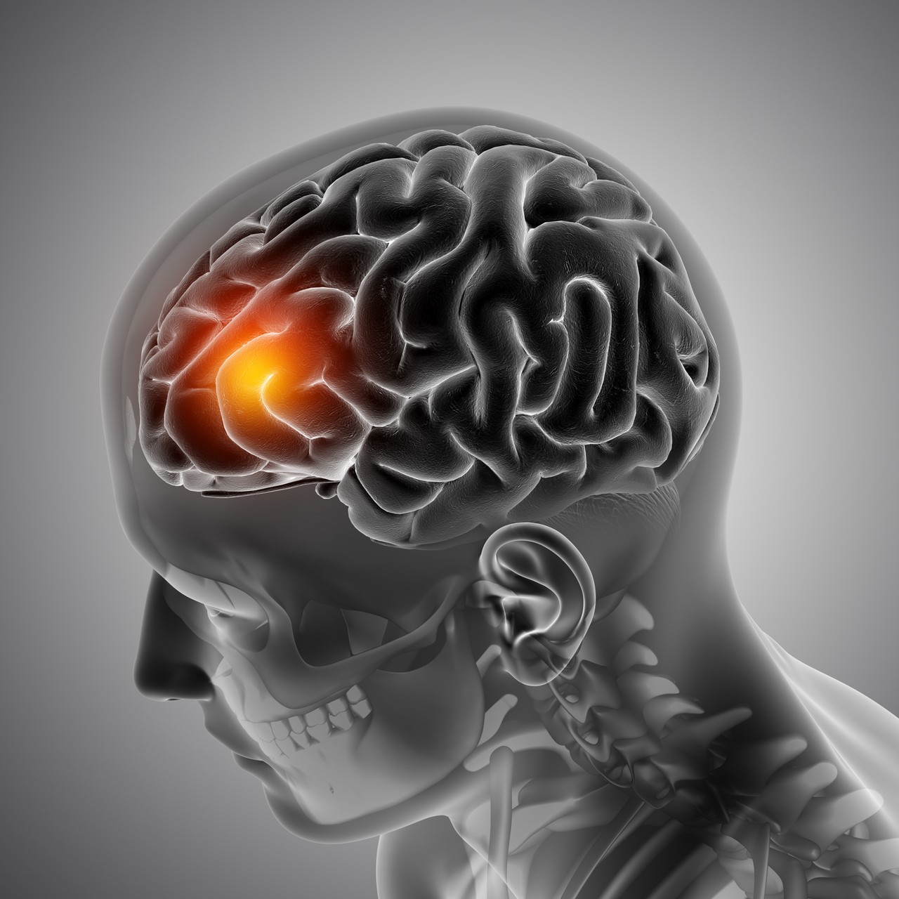 Thiểu sản tiểu não 1