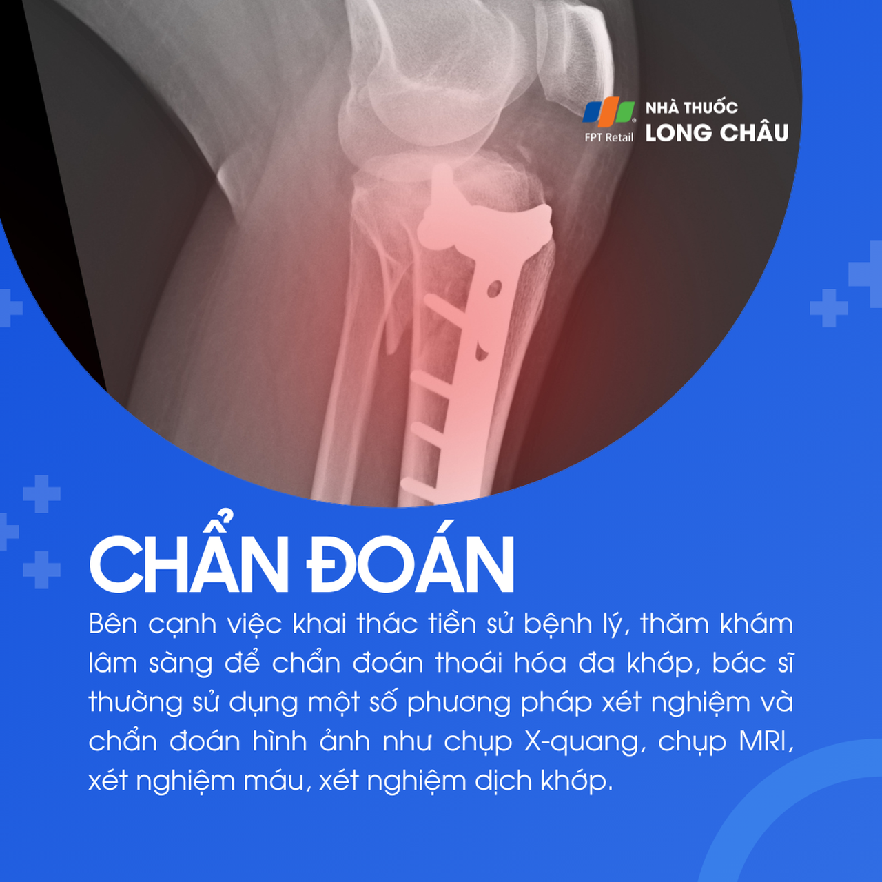 Thoái hóa đa khớp 5