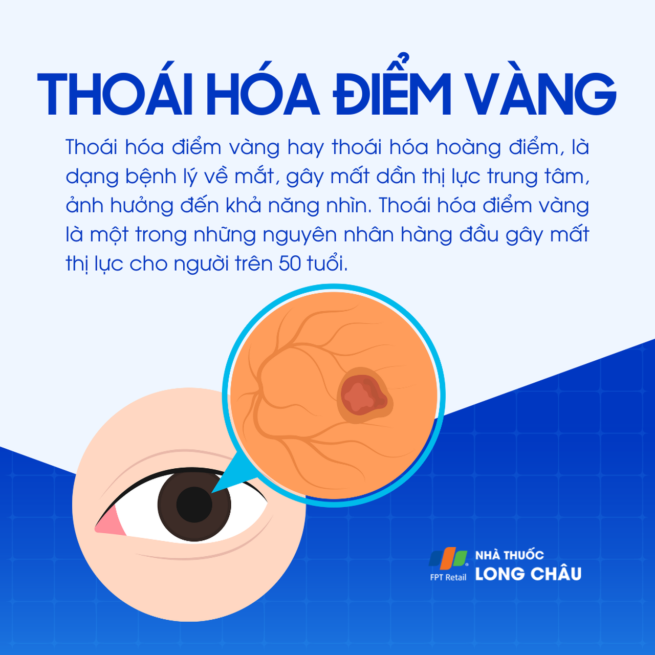 Thoái hóa điểm vàng 1