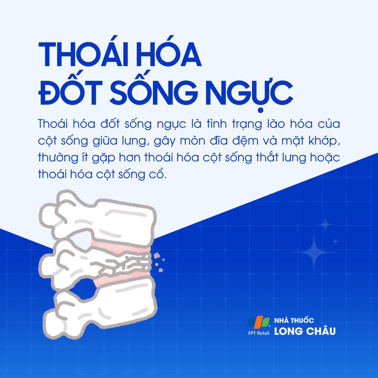Thoái hóa đốt sống ngực 1