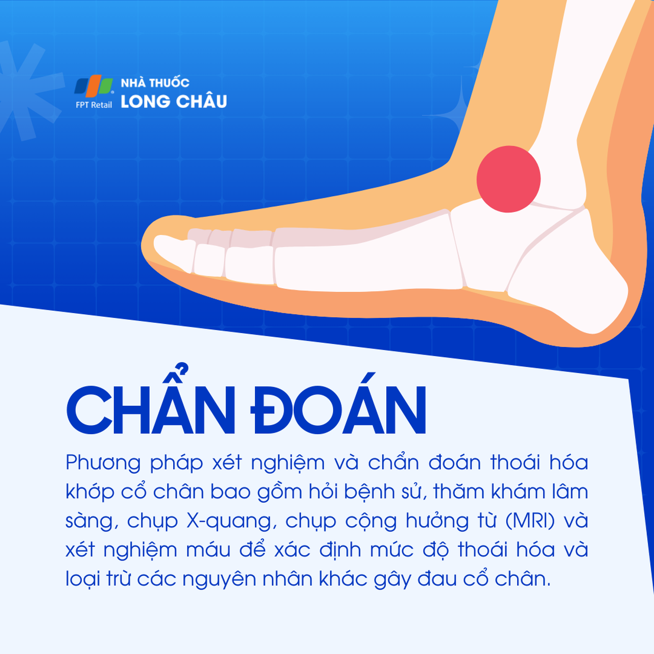 Thoái hóa khớp cổ chân 5