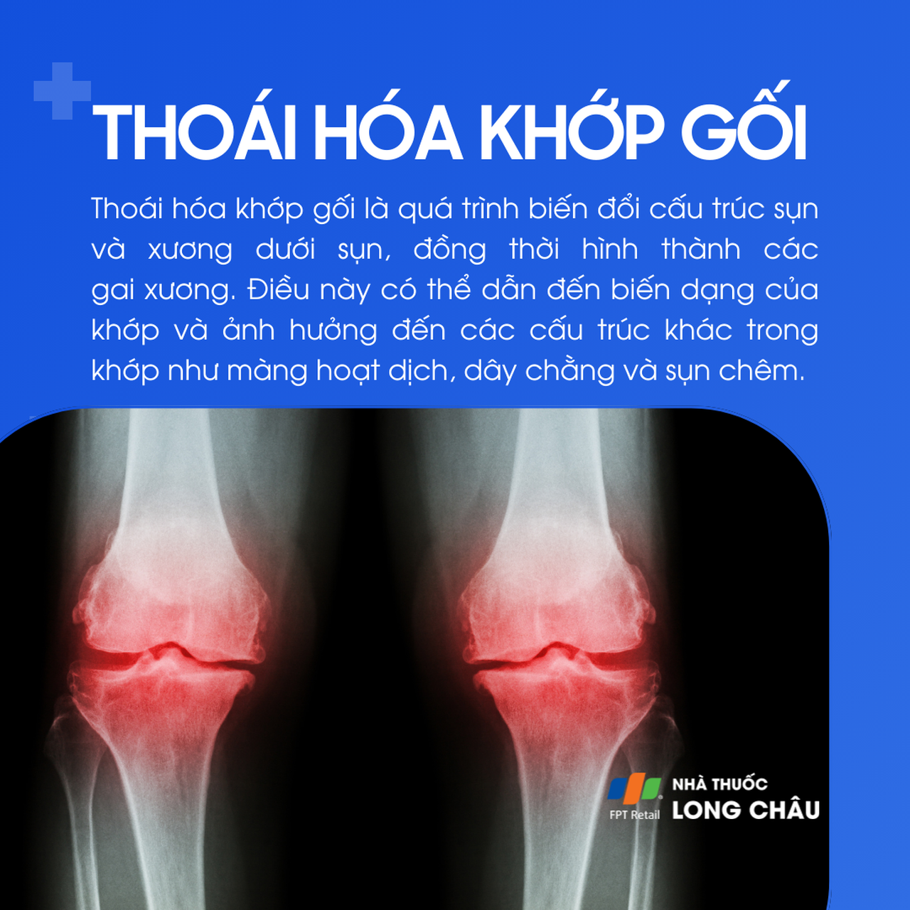 Thoái hóa khớp gối 1