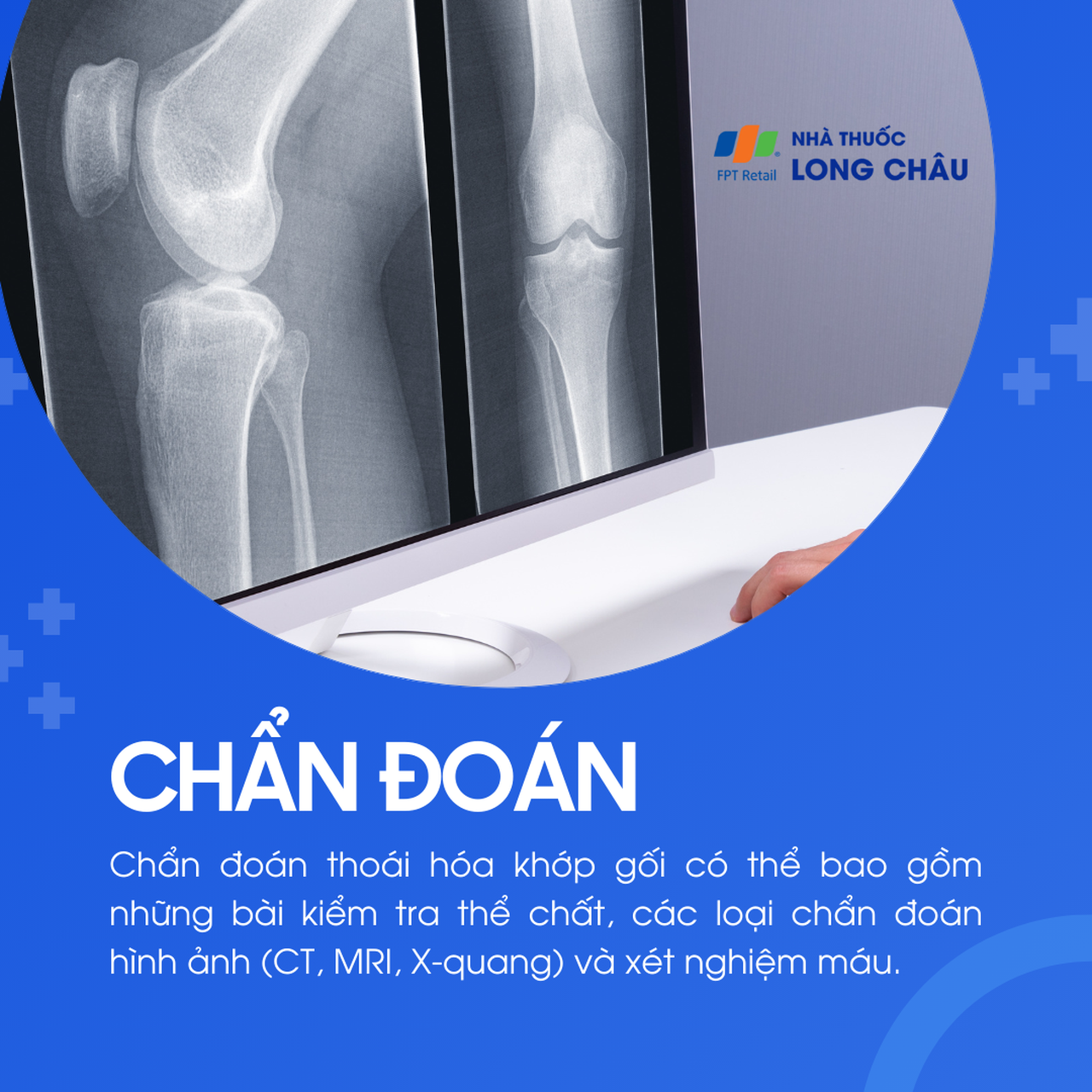 Thoái hóa khớp gối 5