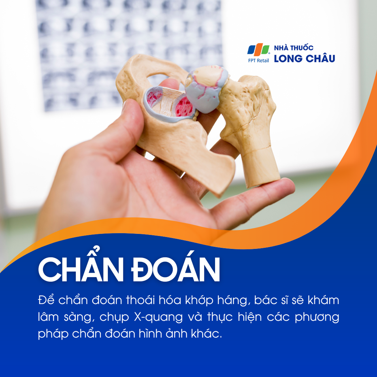 Thoái hóa khớp háng 5