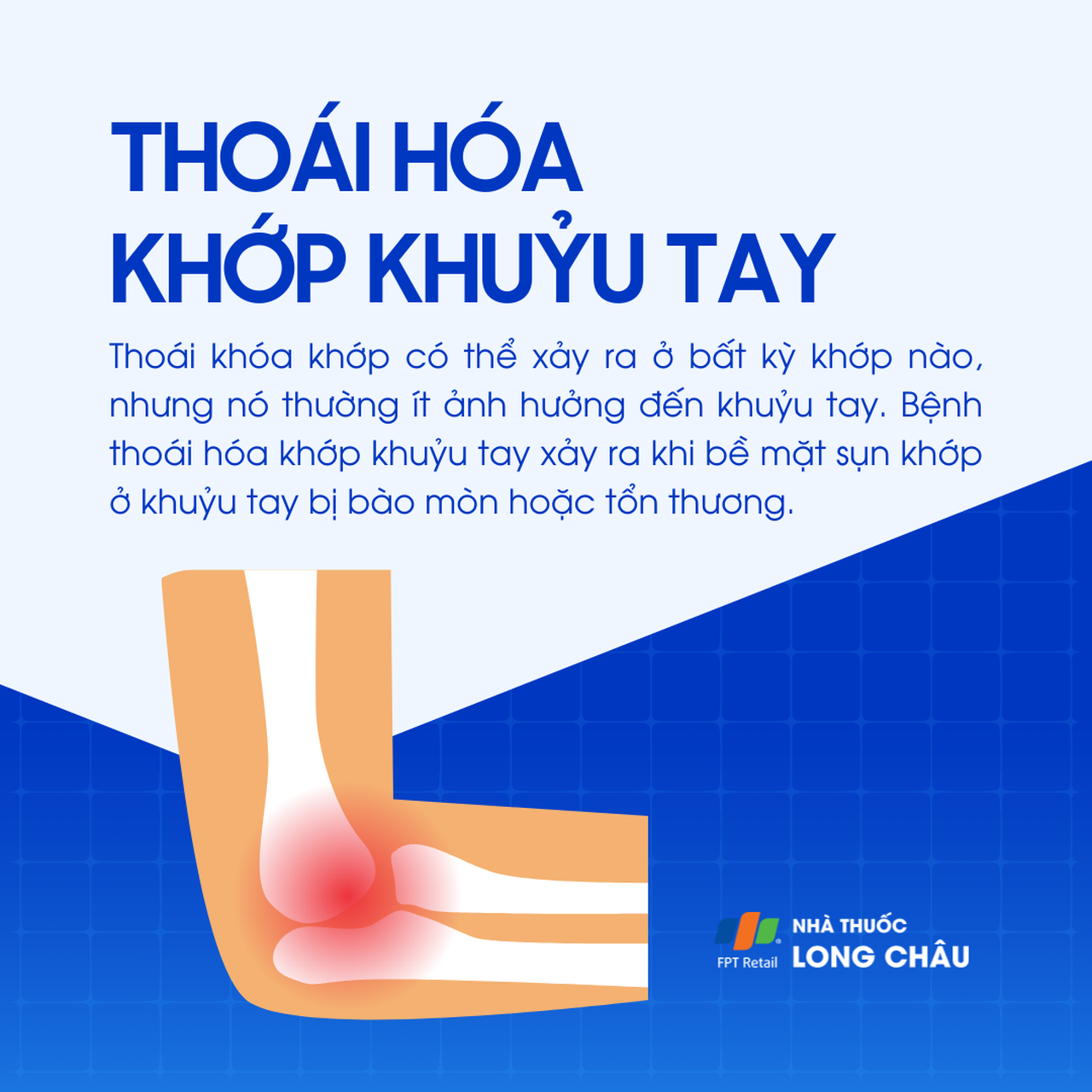 Thoái hóa khớp khuỷu tay 1