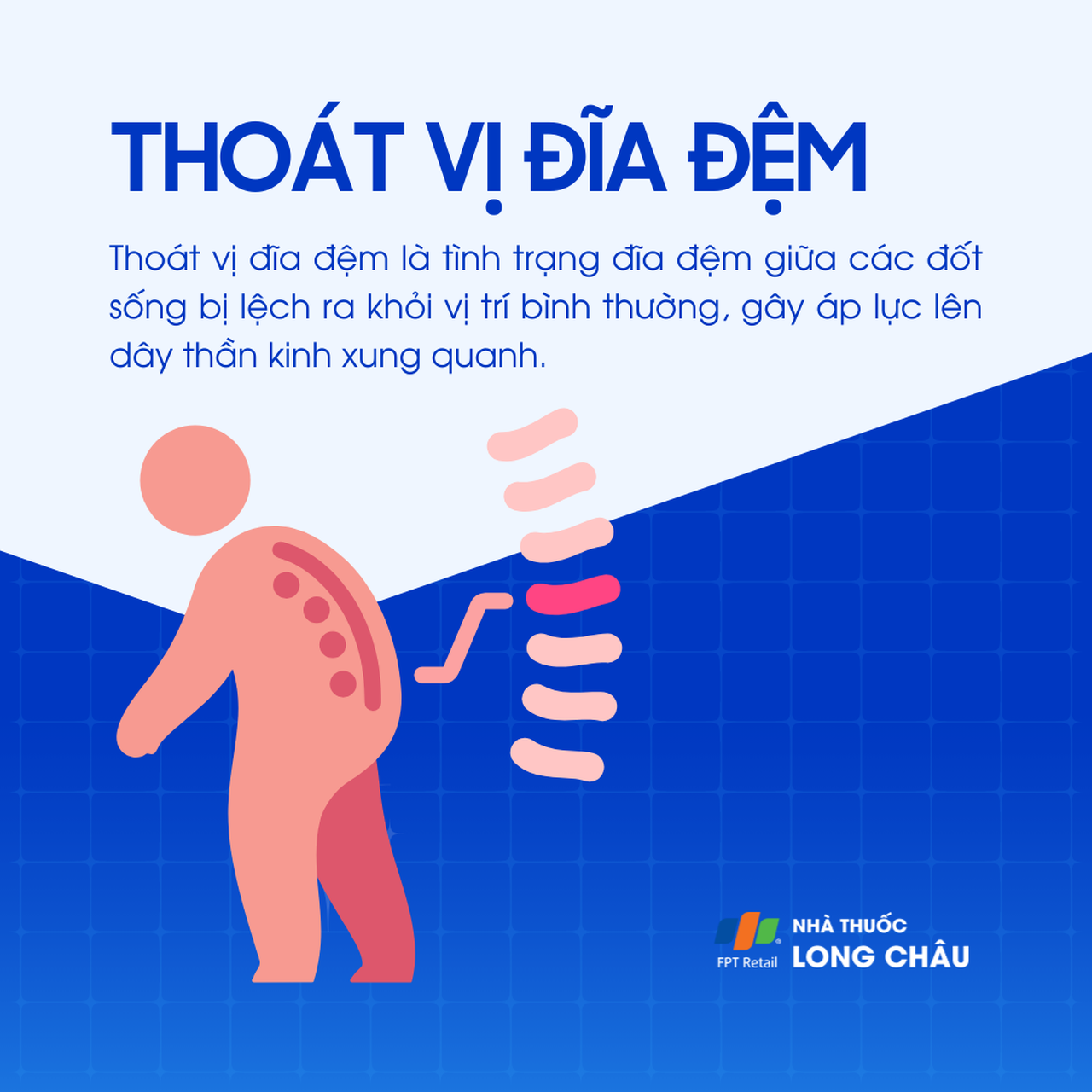tình trạng đĩa đệm lệch khỏi vị trí bình thường gây áp lực lên dây thần kinh