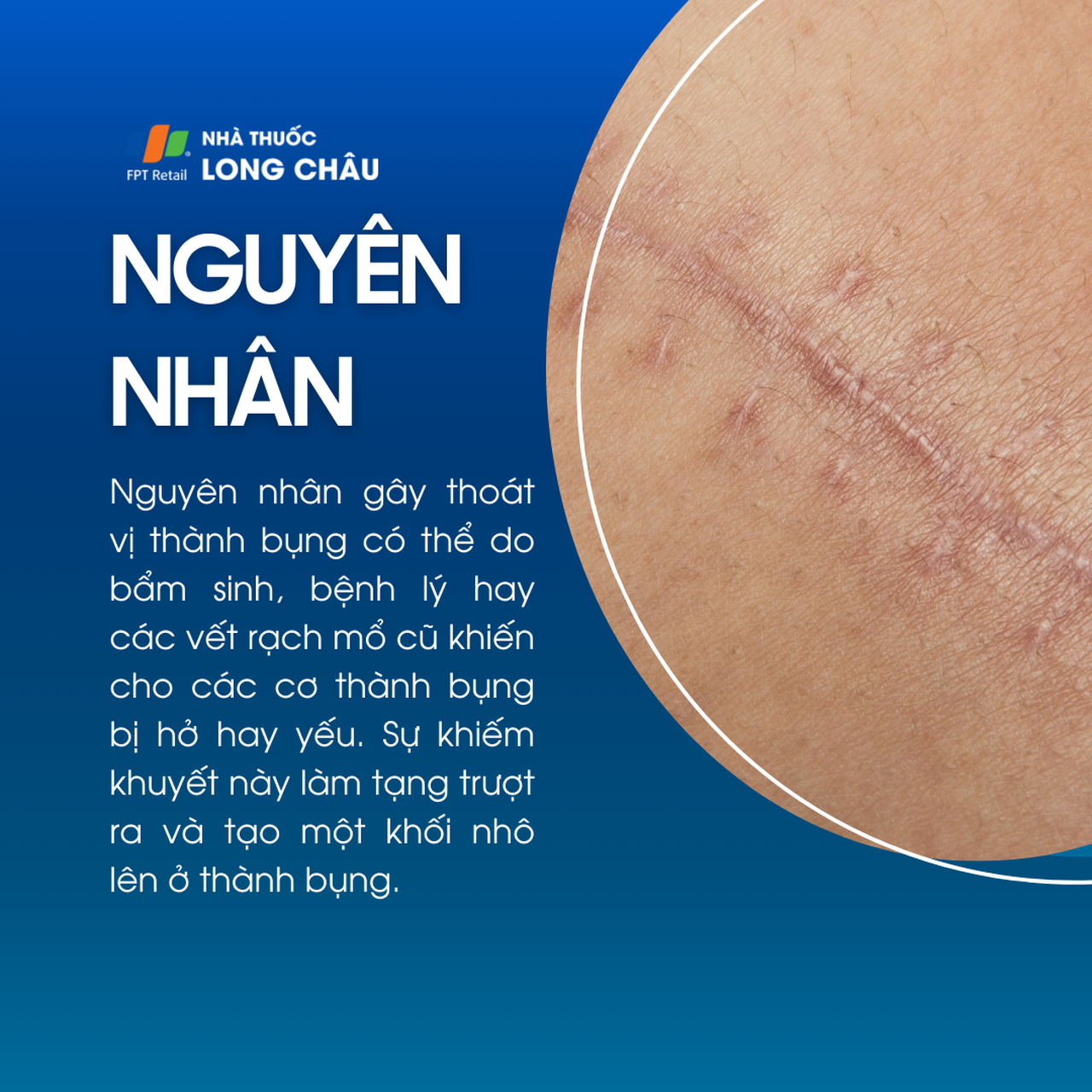 Thoát vị thành bụng 3