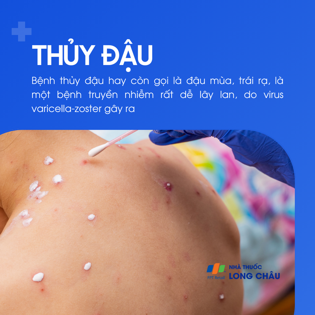 Bệnh thủy đậu là một bệnh truyền nhiễm do virus Varicella zoster gây ra, rất dễ lây