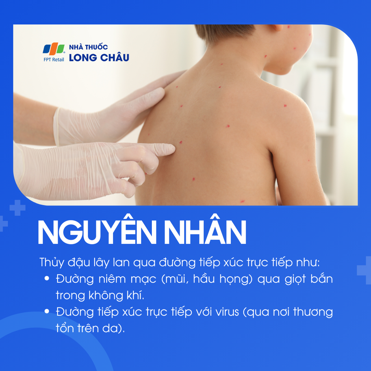Nguyên nhân gây bệnh thủy đậu do virus Varicella-zoster lây qua đường hô hấp