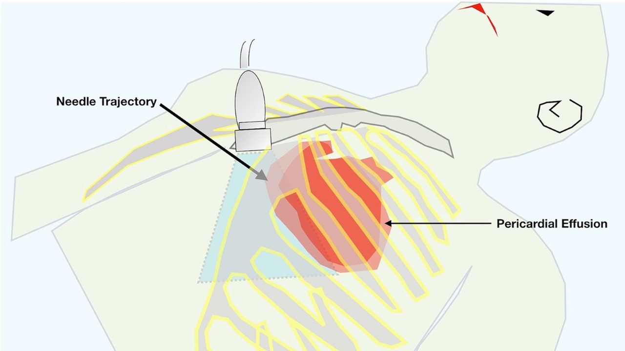  Tràn dịch màng tim: Triệu chứng, nguyên nhân, chẩn đoán và điều trị 3