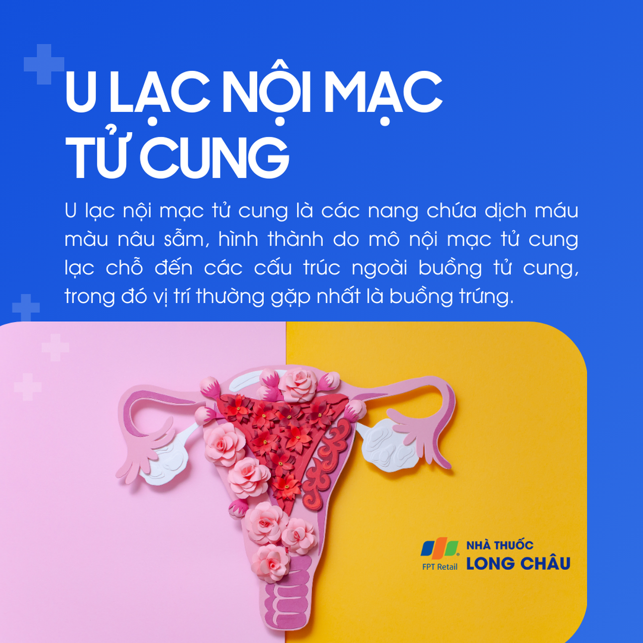 U lạc nội mạc tử cung 1