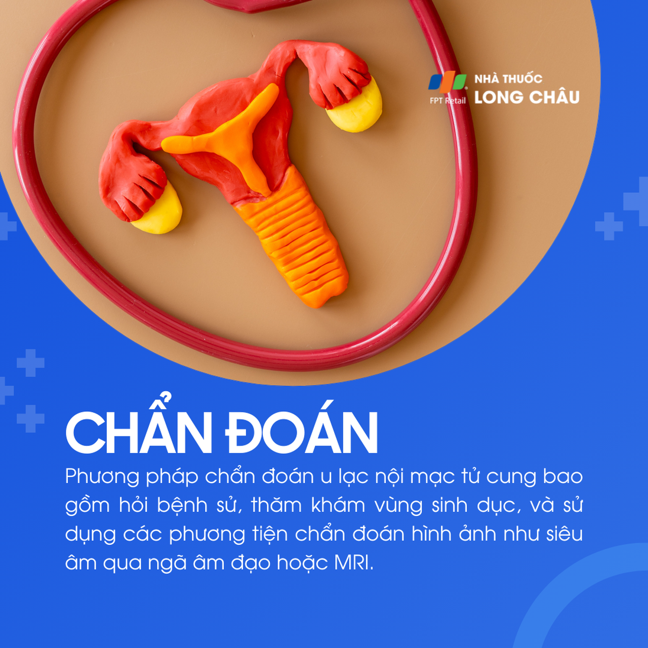 U lạc nội mạc tử cung 5