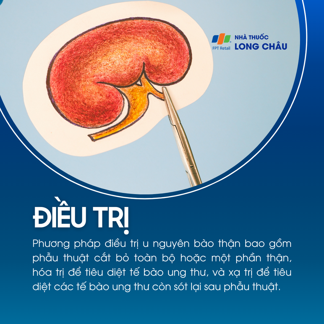 U nguyên bào thận 6