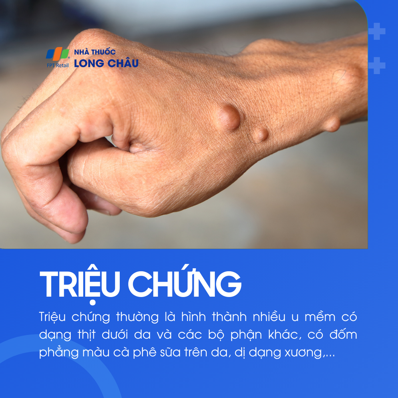 U sợi thần kinh 2