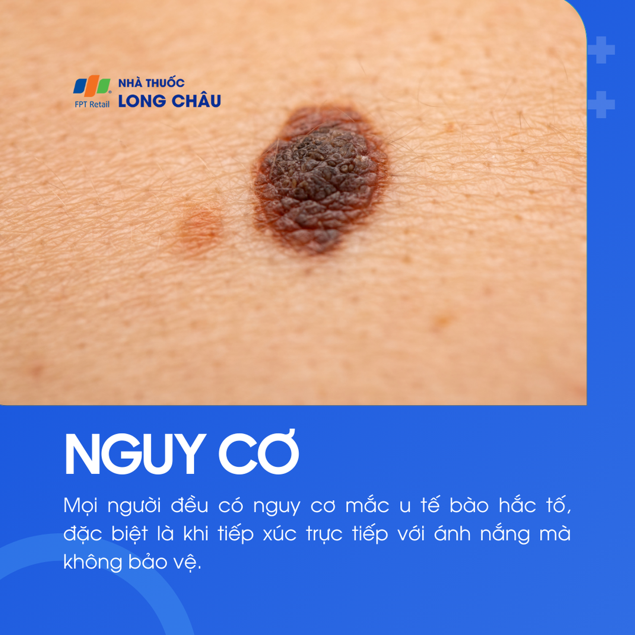 U tế bào hắc tố 4