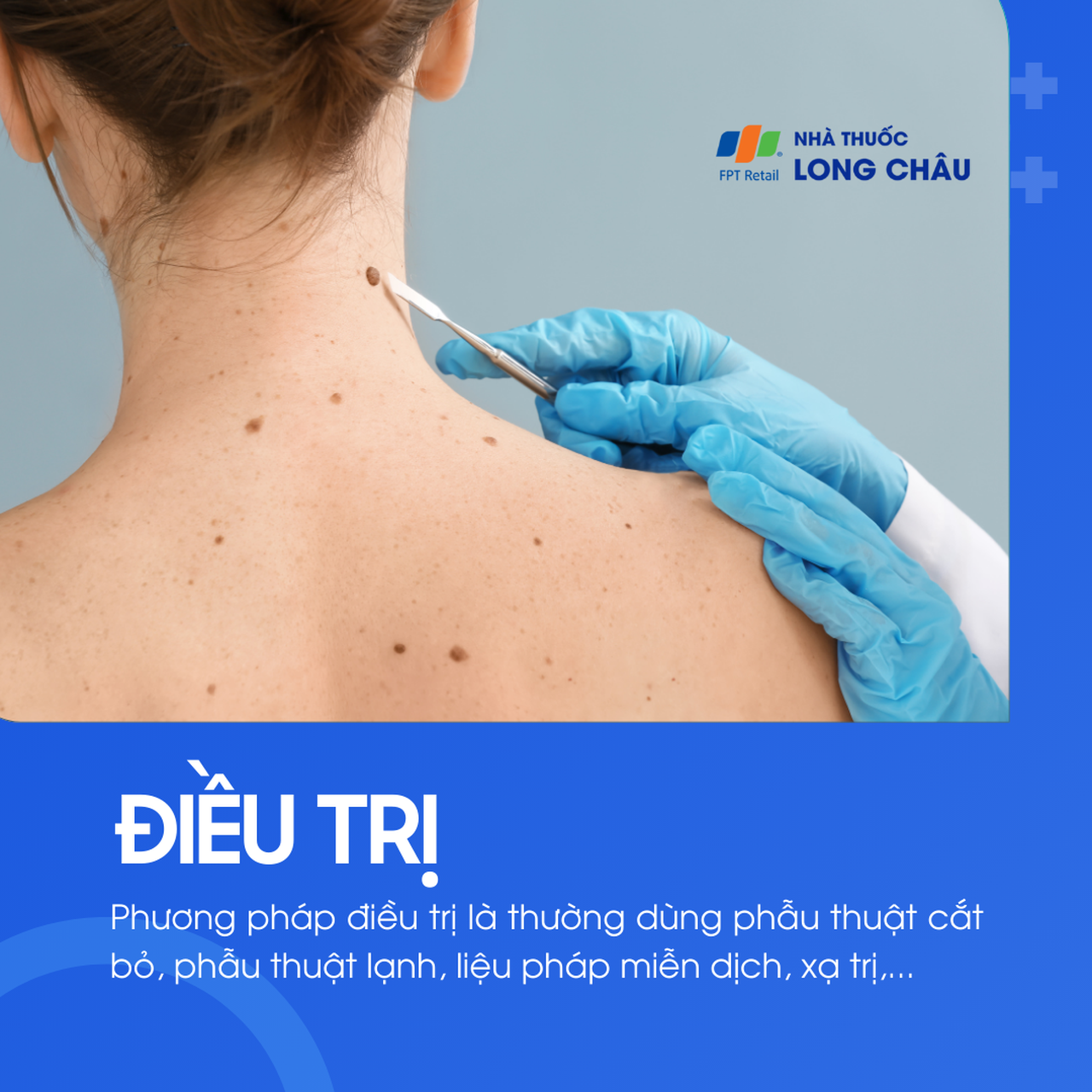 U tế bào hắc tố 6