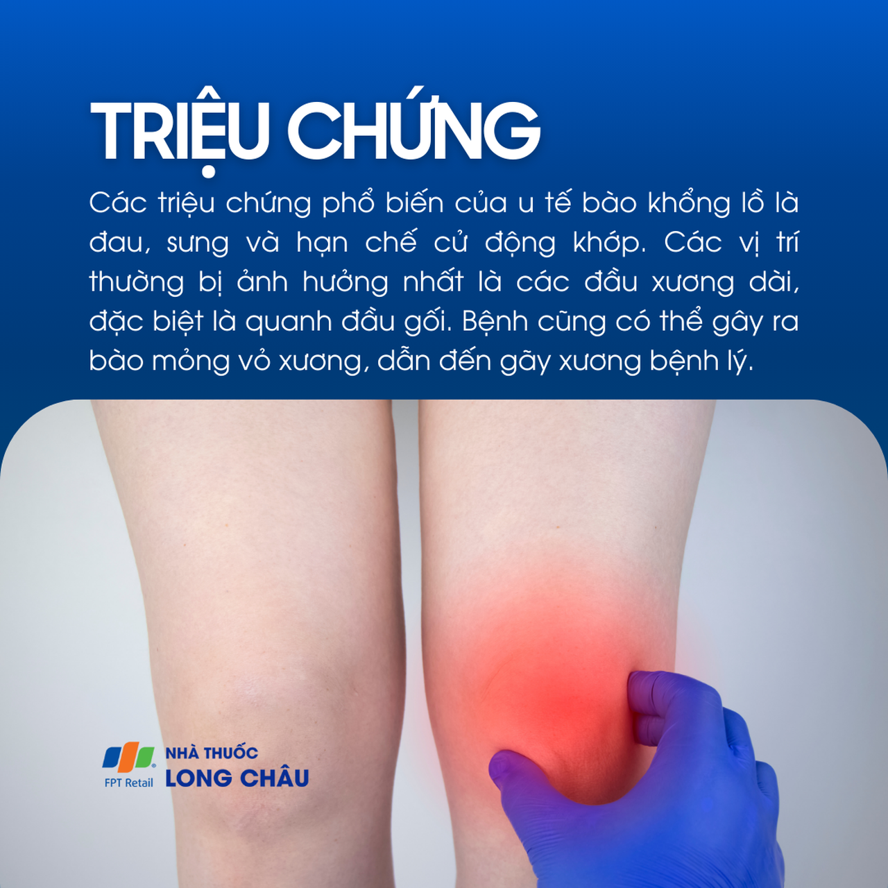 U tế bào khổng lồ 2