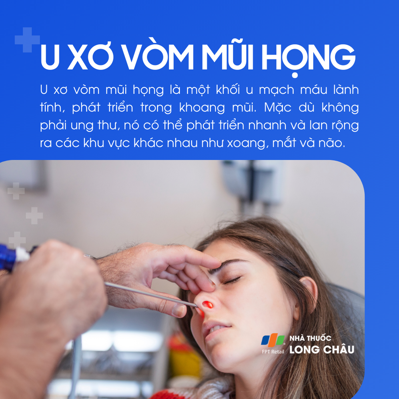 U xơ vòm mũi họng 1