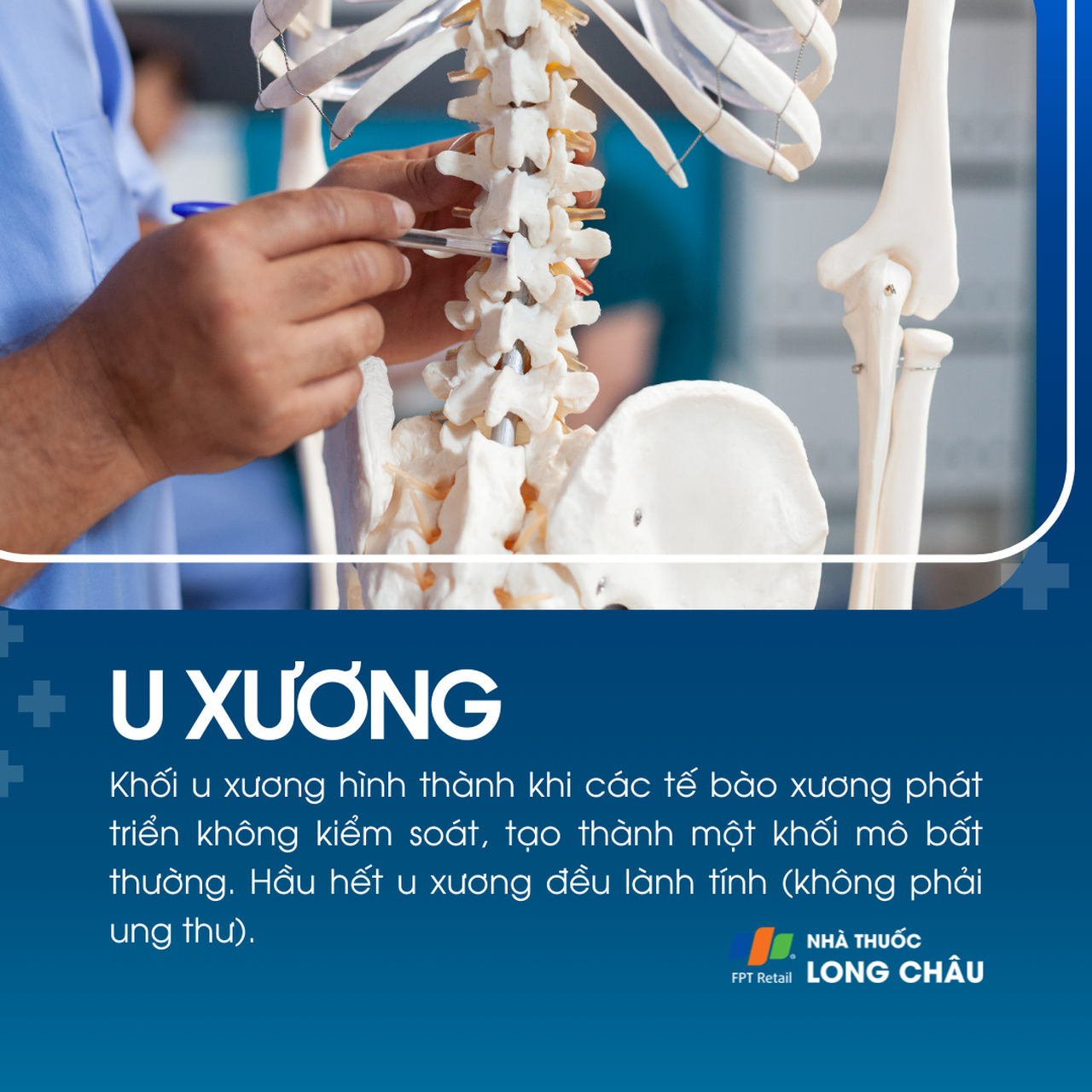 U xương 1