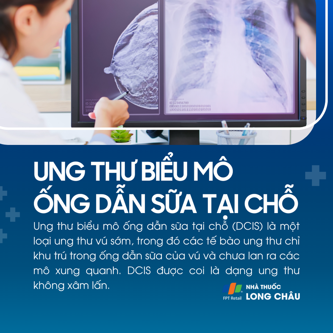 Ung thư biểu mô ống dẫn sữa tại chỗ 1