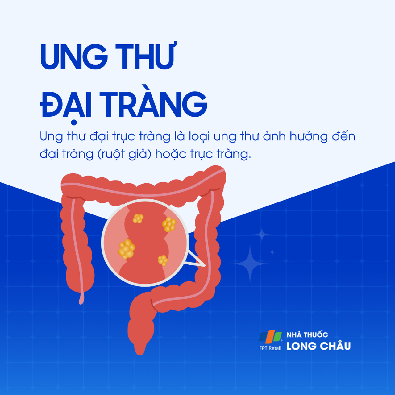 Ung thư đại tràng 1