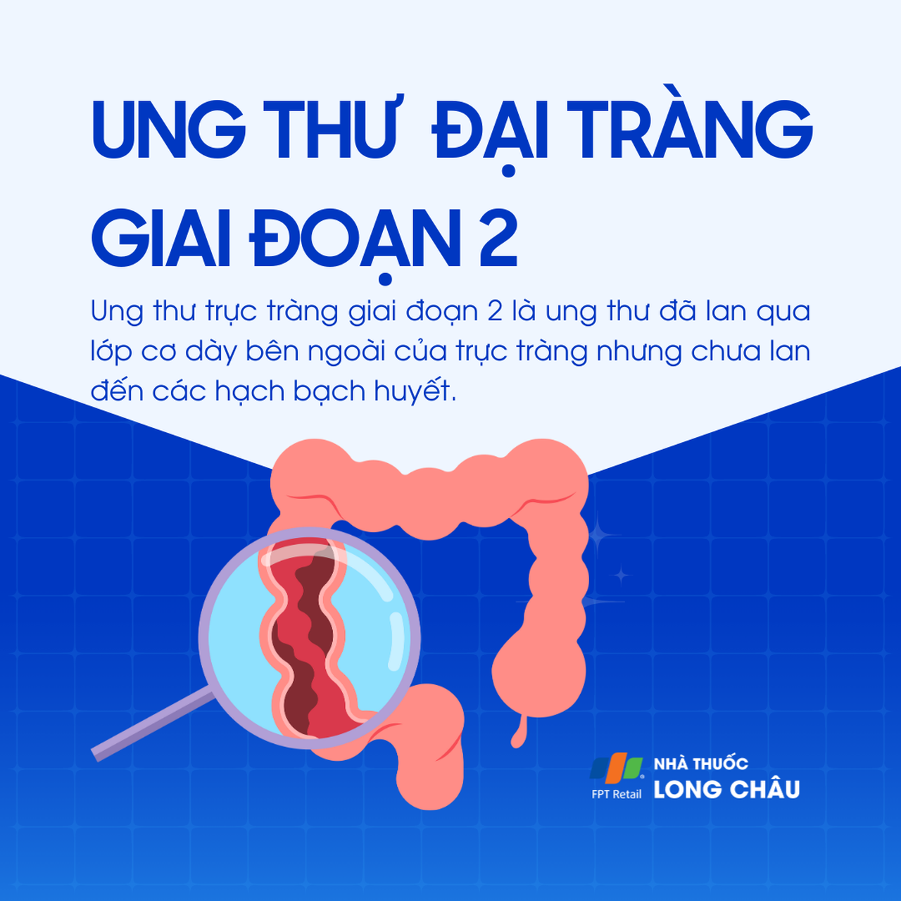 Ung thư đại tràng giai đoạn 2 1