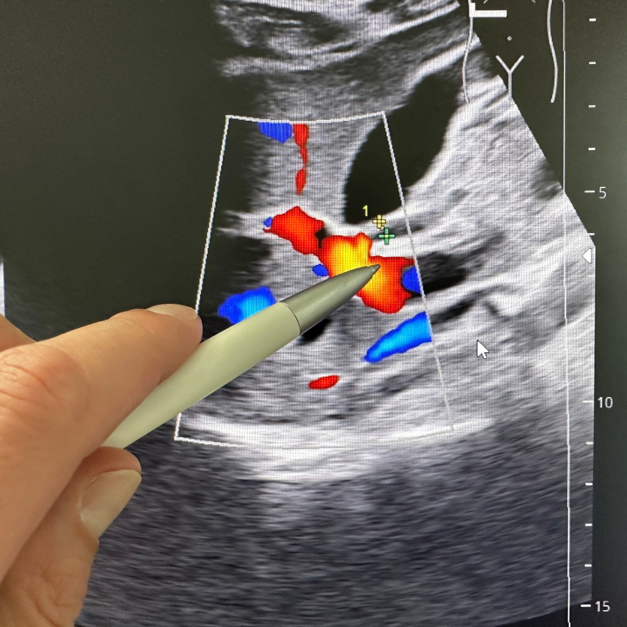  Ung thư đường mật 2