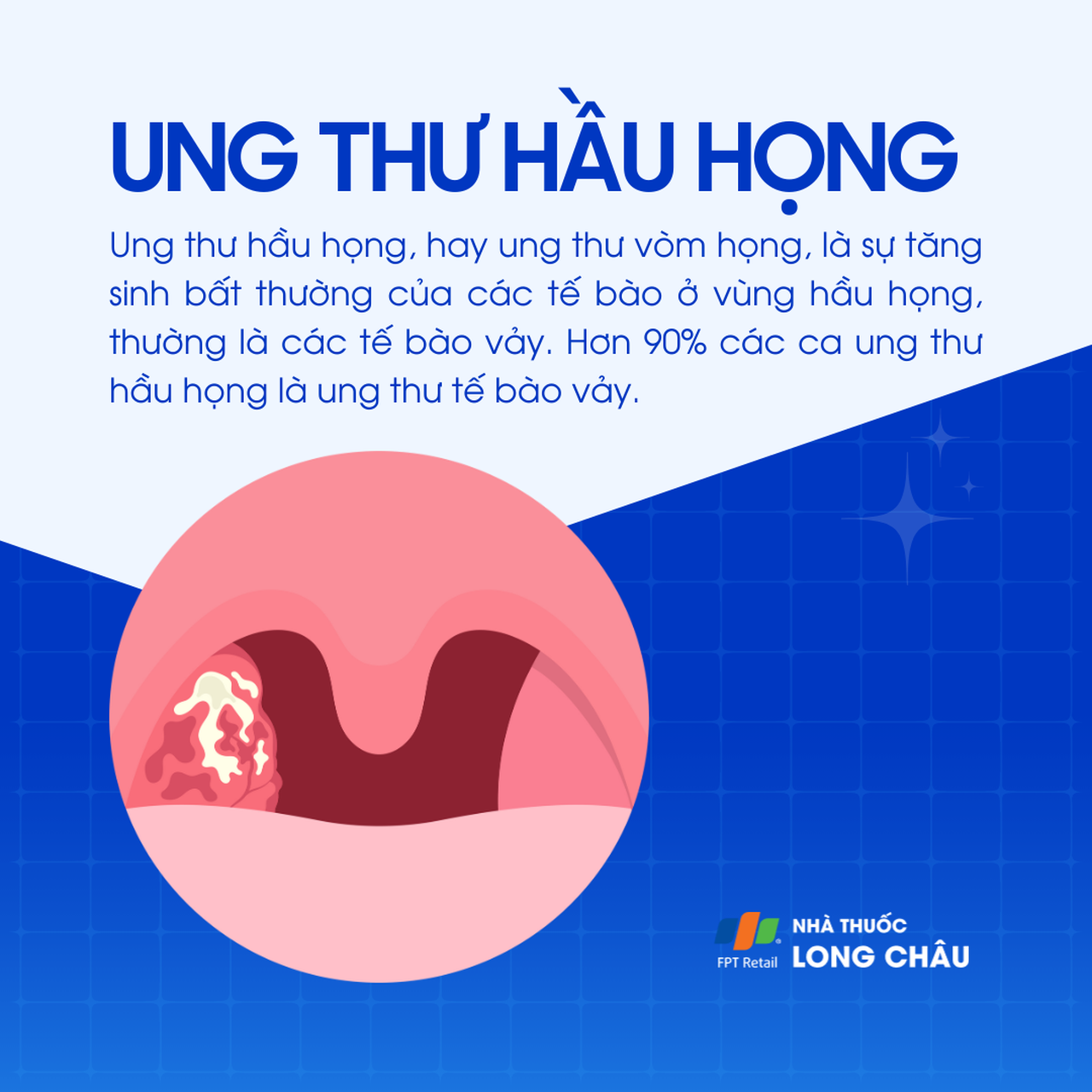 Ung thư hầu họng 1
